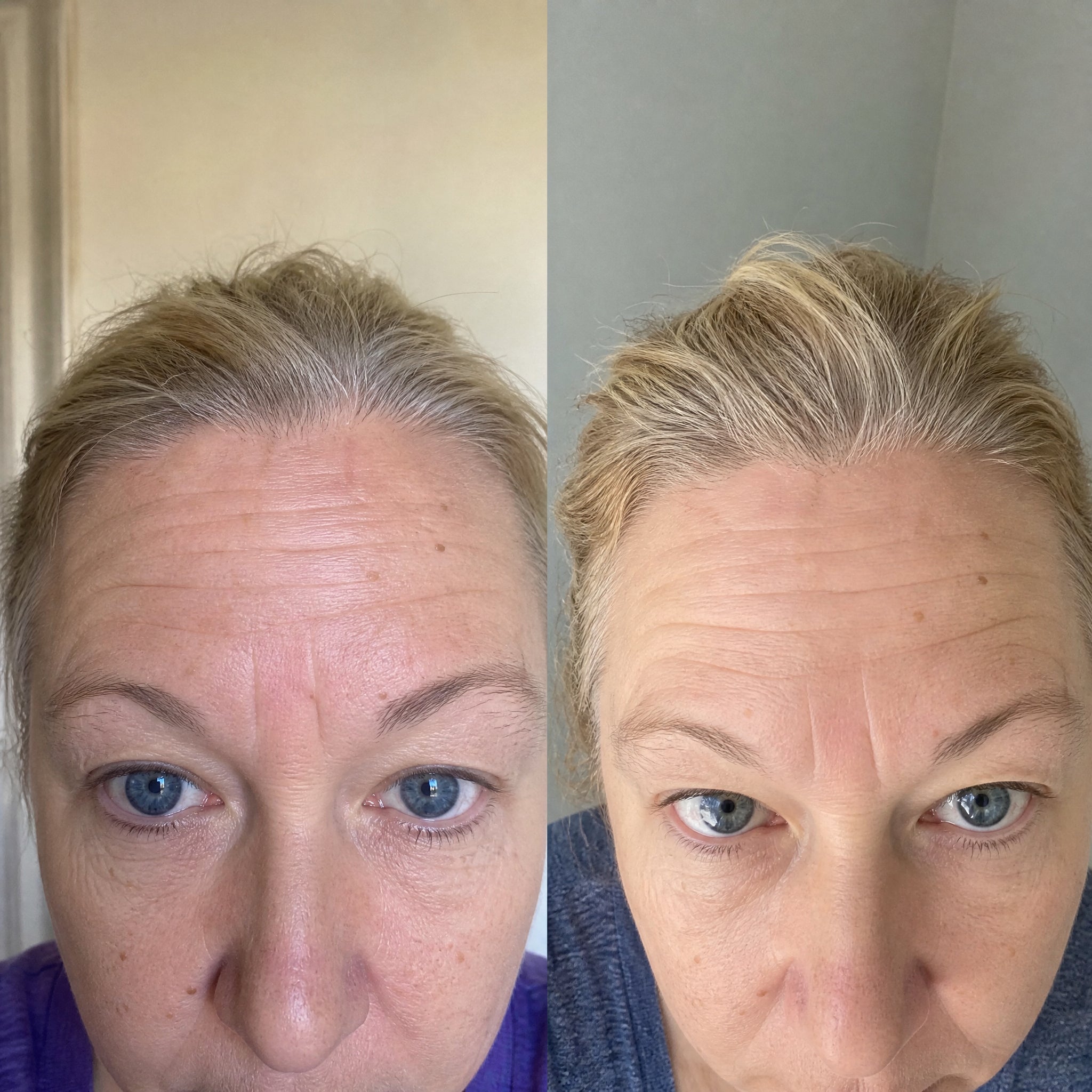 Before and after photographs from a Skingenetix customer, showing overall brightness, forehead softening