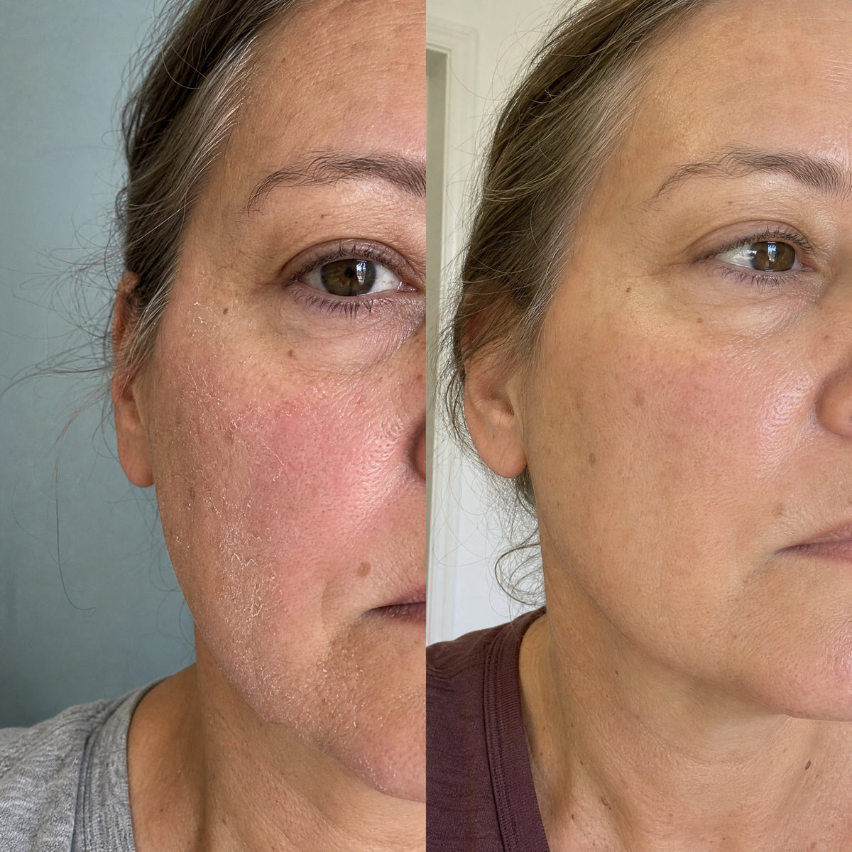 Before and after photographs from a Skingenetix customer, showing cheek redness calming to an even tone
