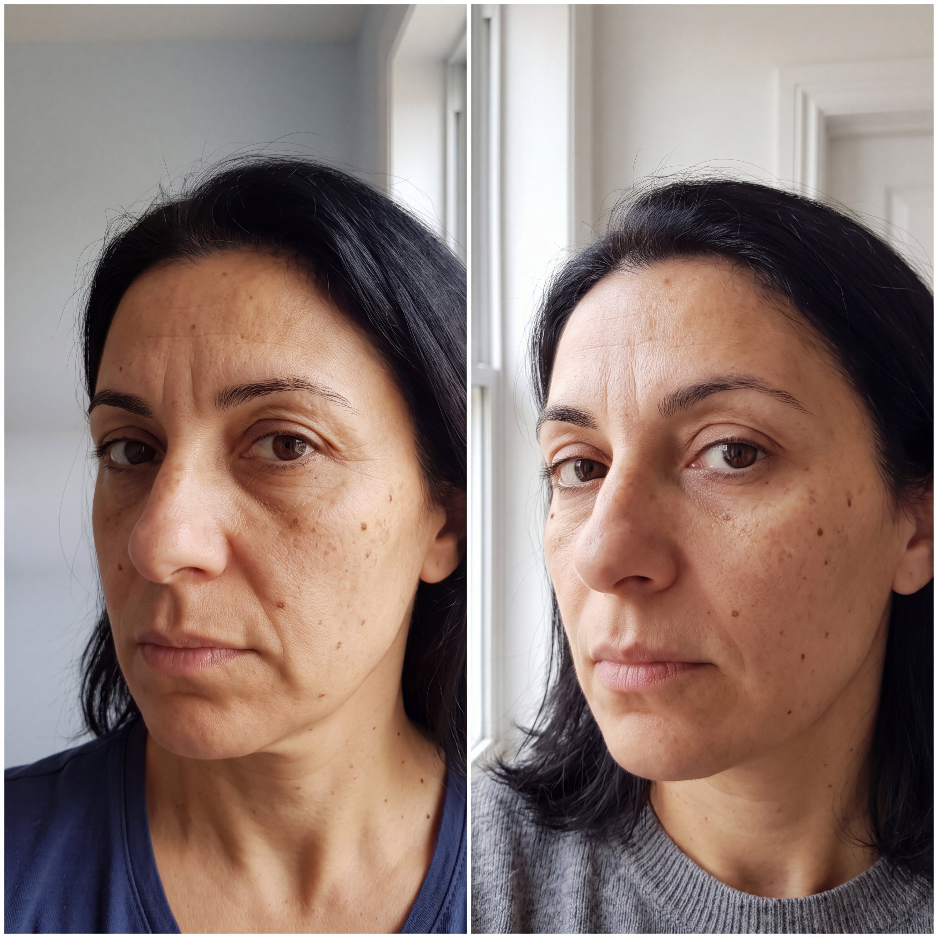 Before and after skin comparison showing softer fine lines and wrinkles