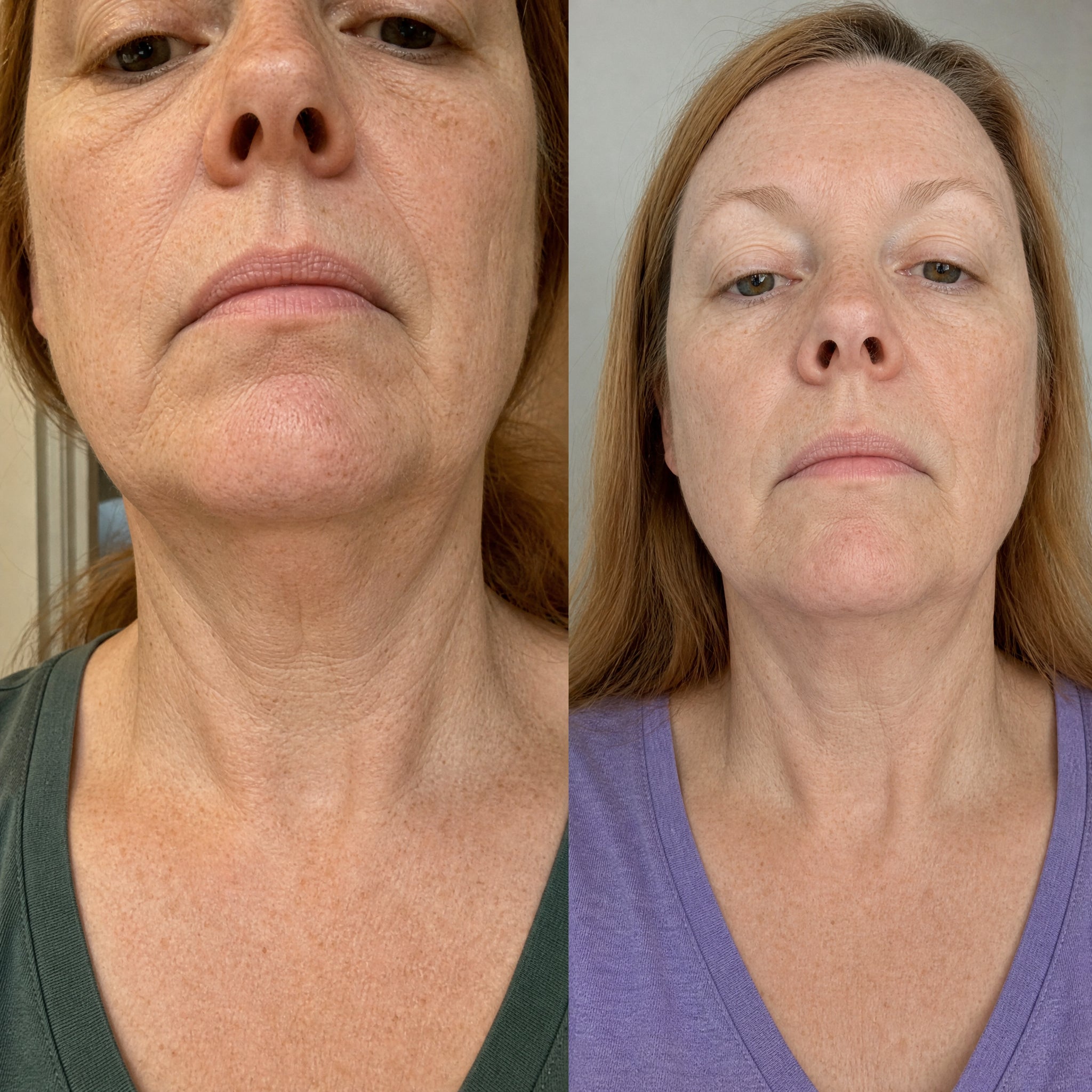 Before and after skin comparison showing firmer, better supported skin along the jaw and cheek