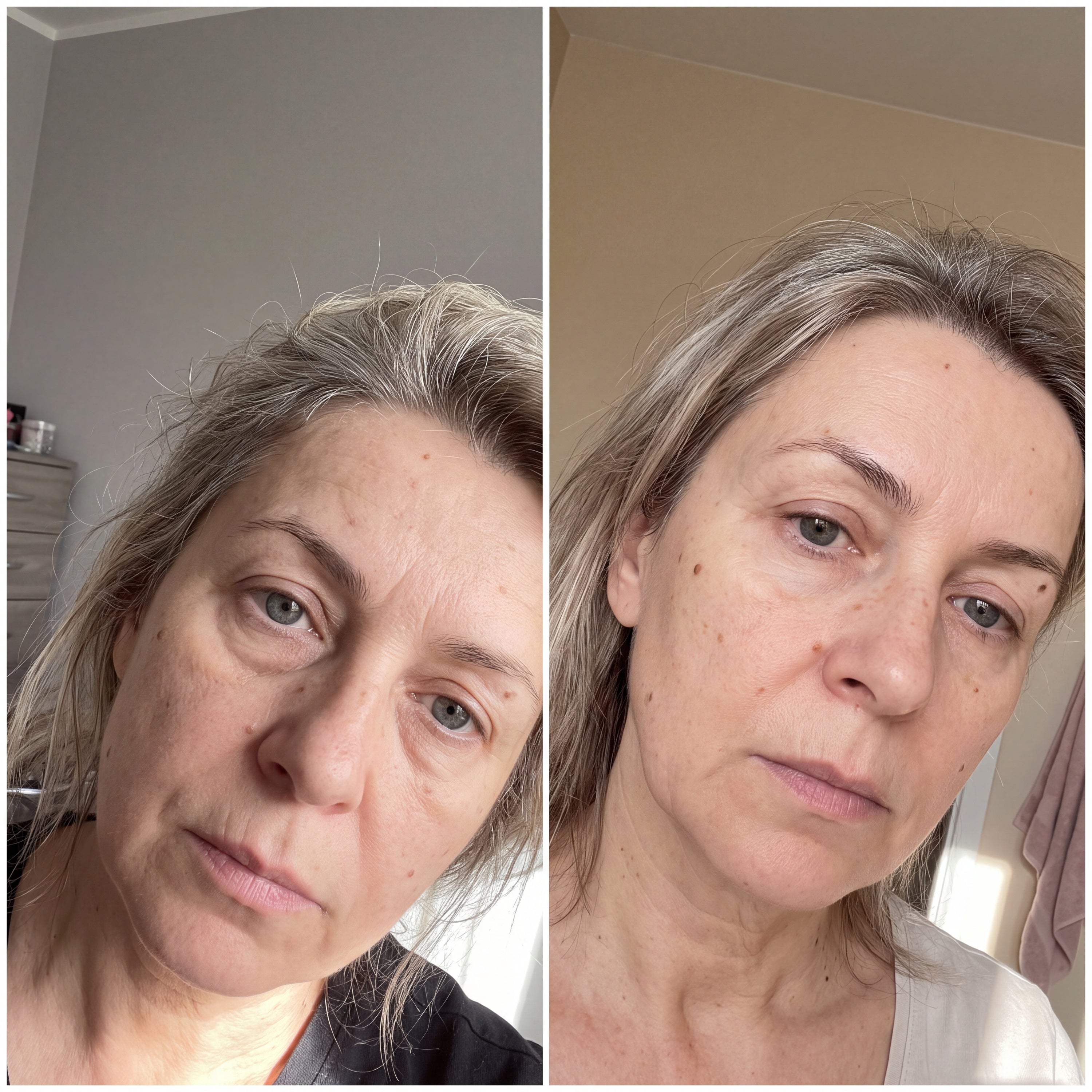 Before and after photographs from a Skingenetix customer, showing jaw and cheek laxity plumping