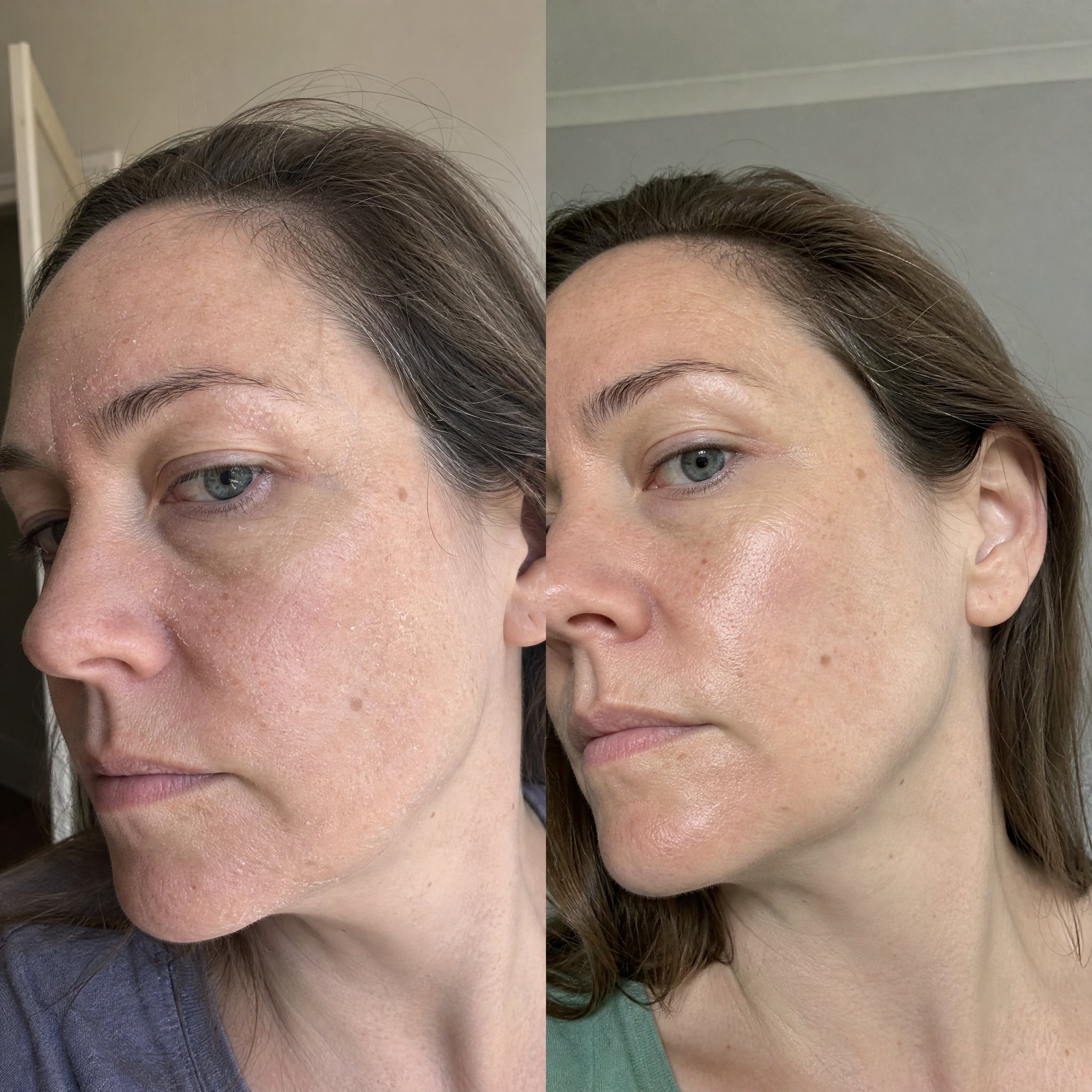 Before and after photographs from a Skingenetix customer, showing nasolabial and cheek firmness