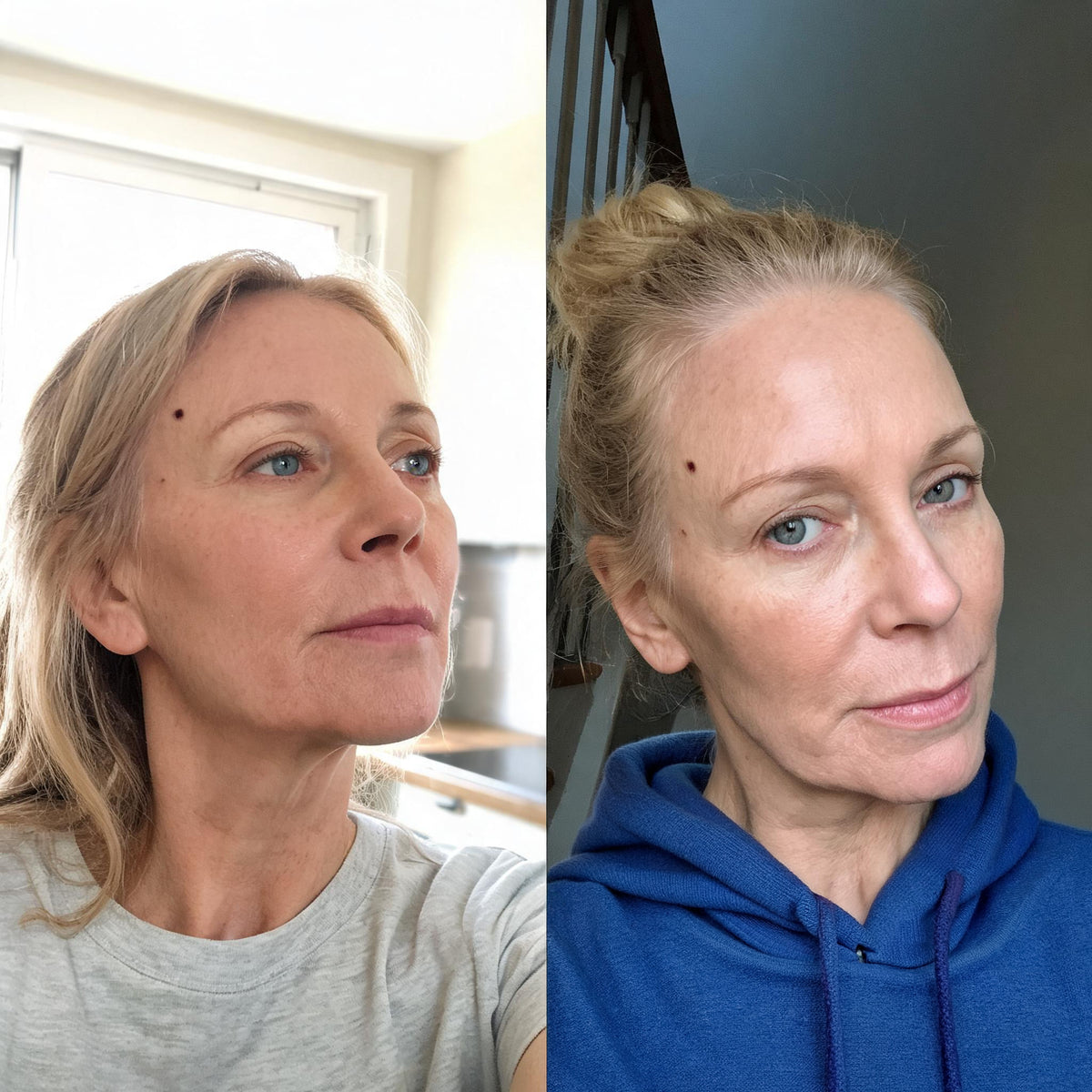 Before and after skin comparison showing firmer, better supported skin along the jaw and cheek