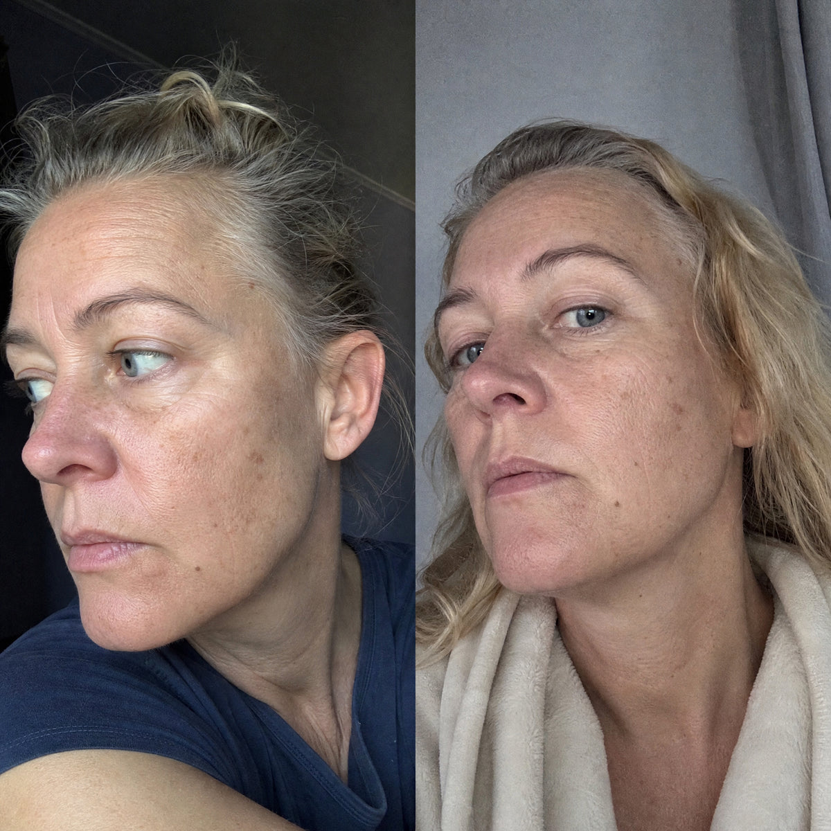 Before and after photographs from a Skingenetix customer, showing jaw and neck firmness