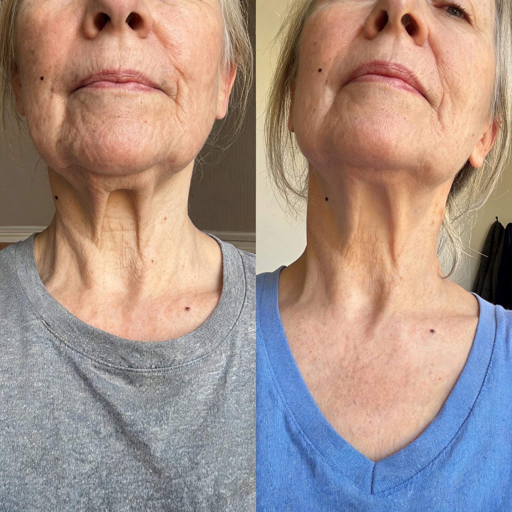 Before and after skin comparison showing firmer, better supported skin along the jaw and cheek