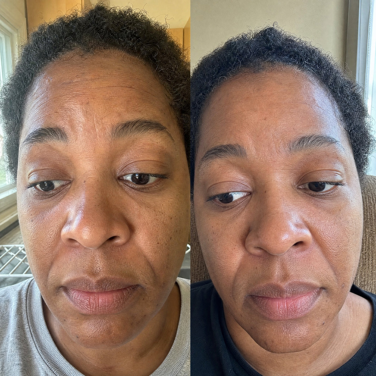Before and after skin comparison showing improved skin condition and texture
