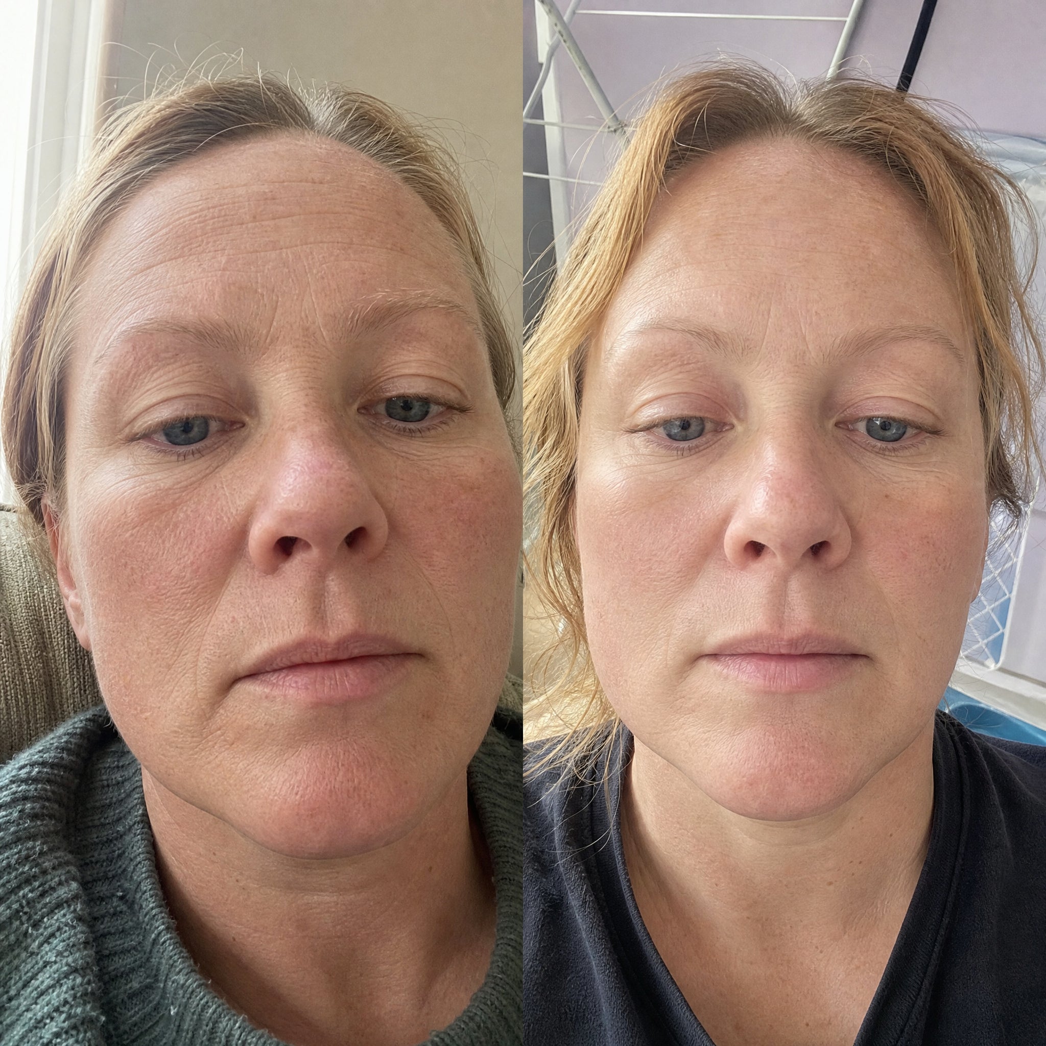 Before and after skin comparison showing improved skin condition and texture