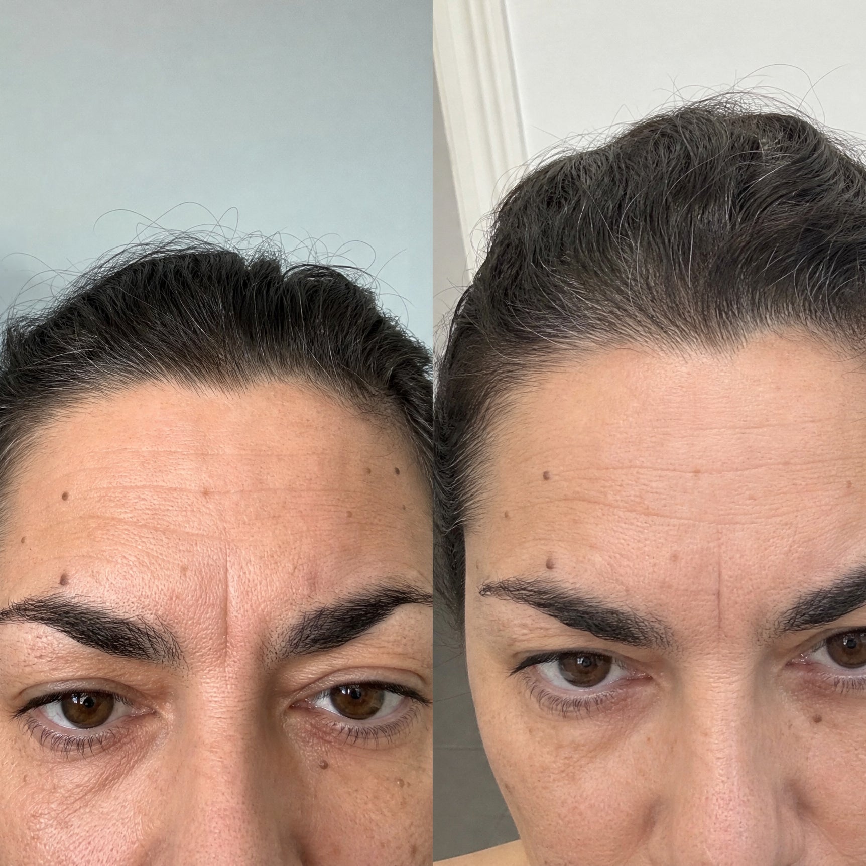 Before and after photographs from a Skingenetix customer, showing forehead and glabellar lines in macro