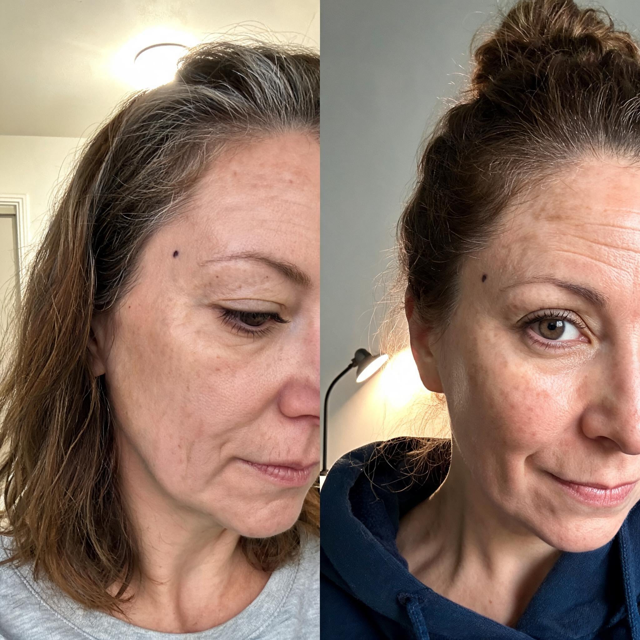 Before and after skin comparison showing softer fine lines and wrinkles