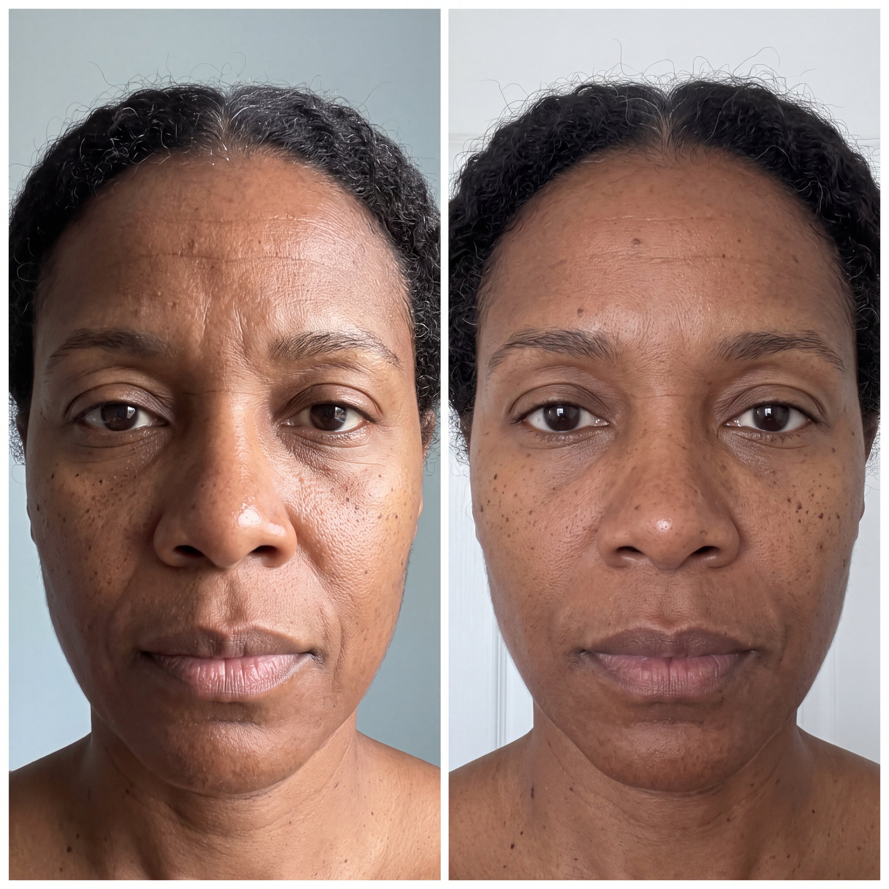 Before and after skin comparison showing softer fine lines and wrinkles