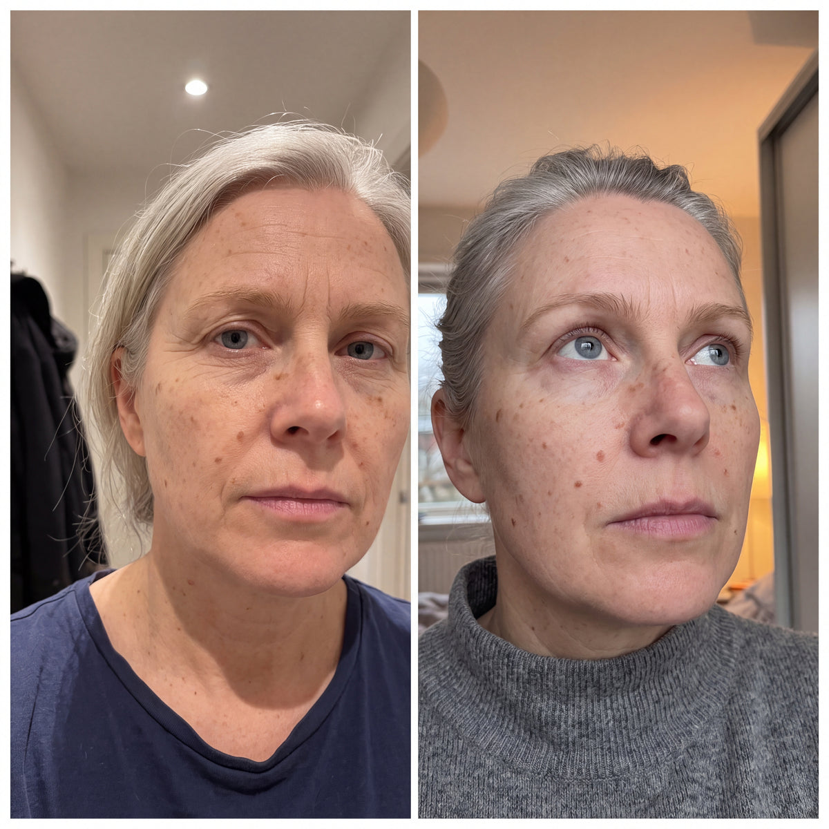 Before and after skin comparison showing softer fine lines and wrinkles