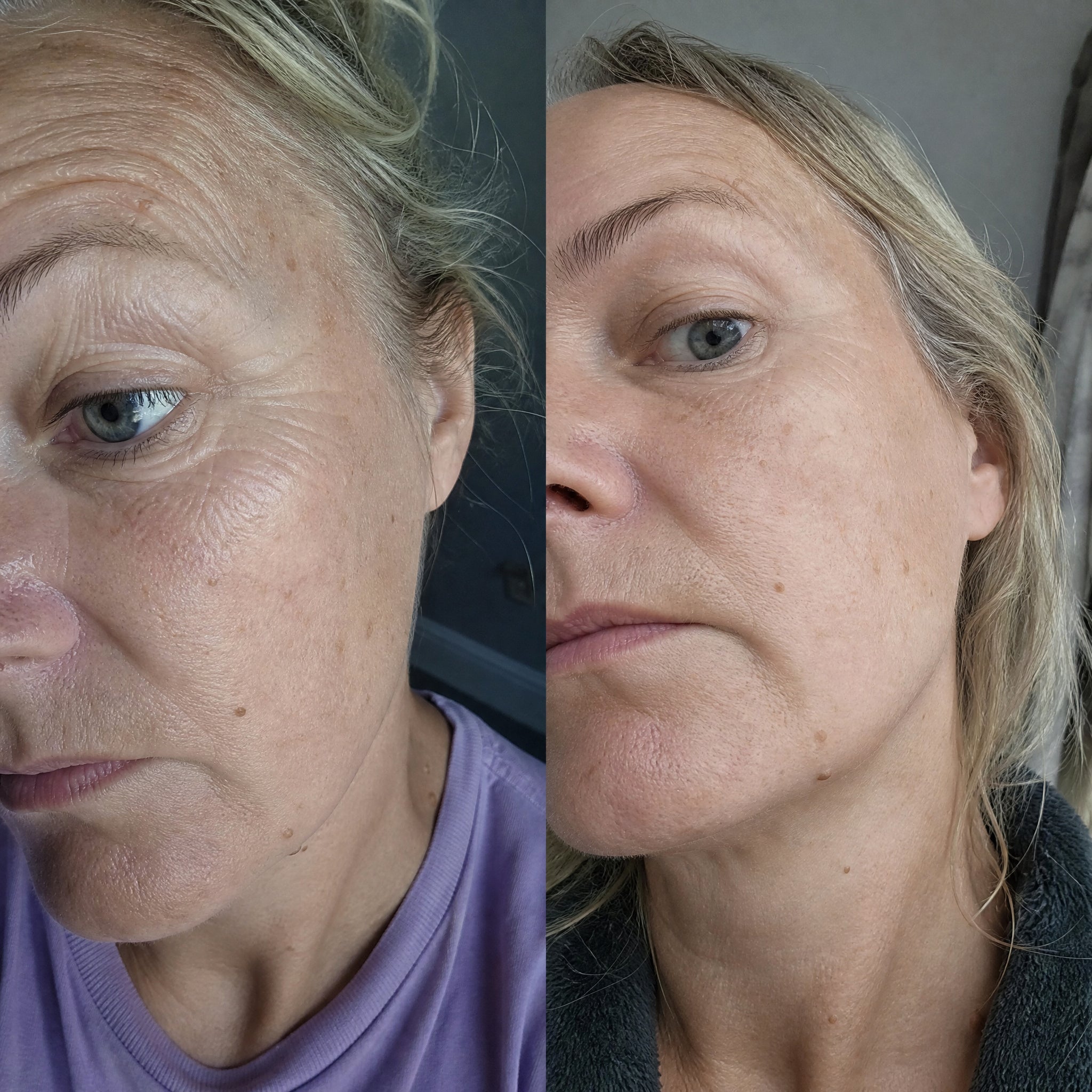 Before and after skin comparison showing softer fine lines and wrinkles