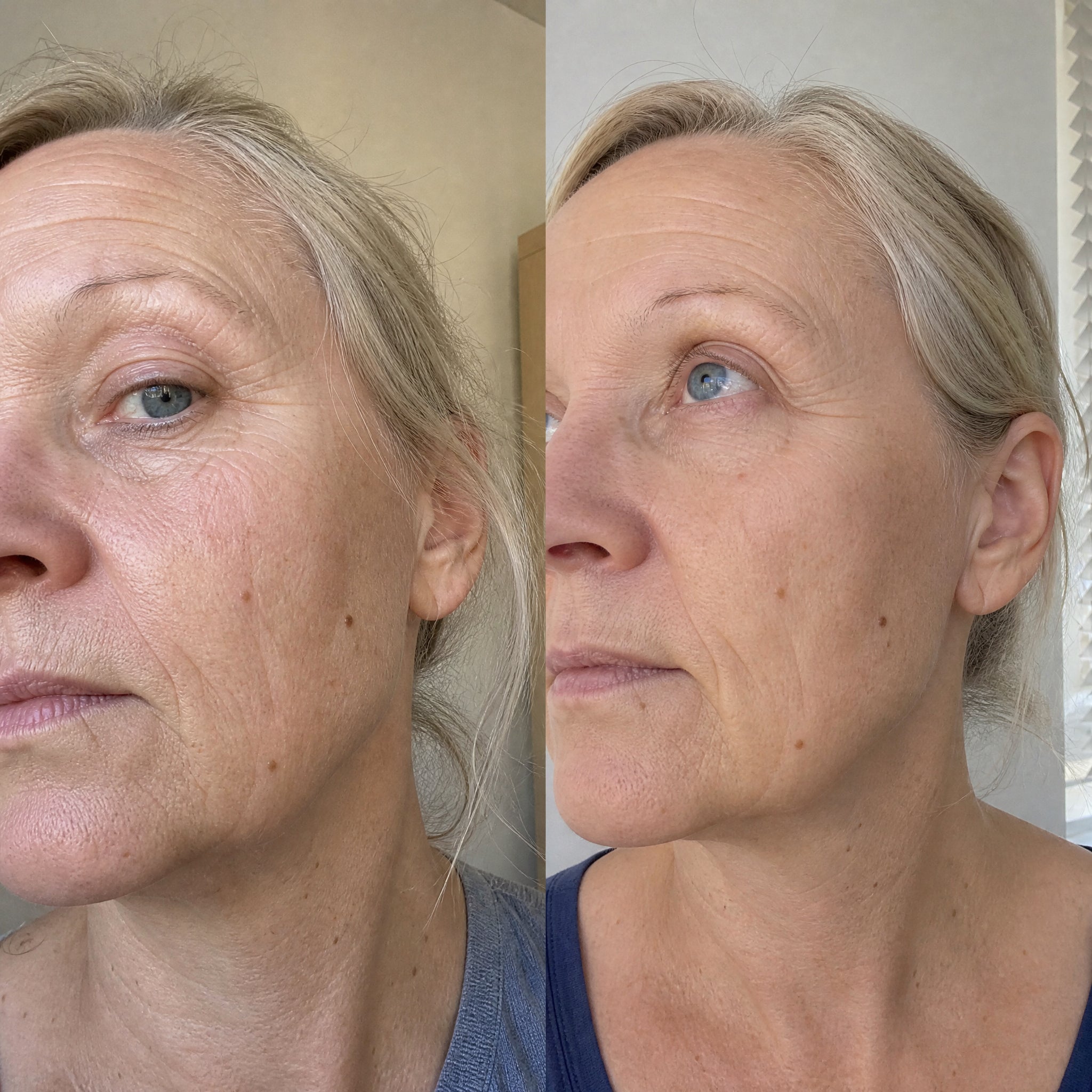 Before and after skin comparison showing softer fine lines and wrinkles