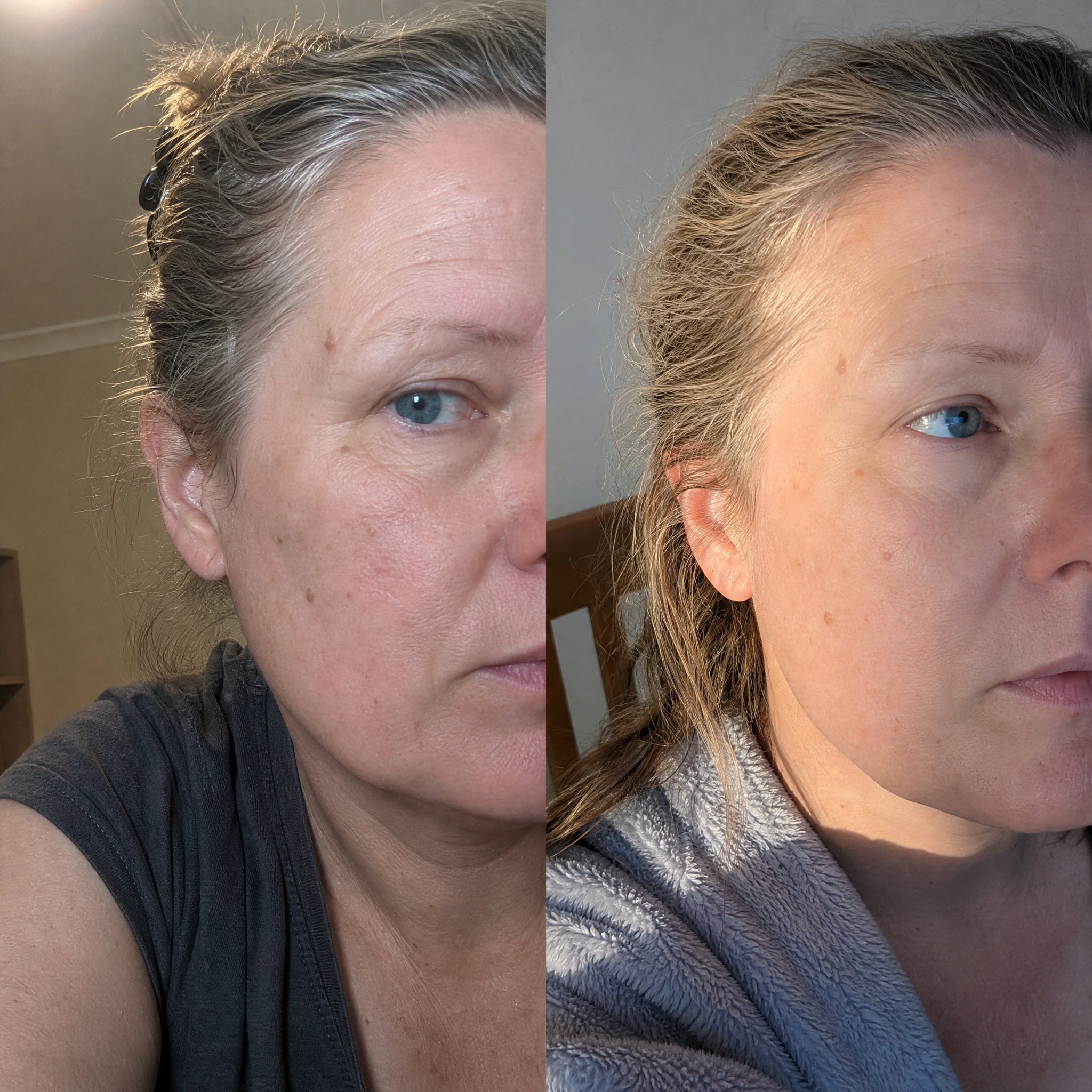 Before and after skin comparison showing softer fine lines and wrinkles