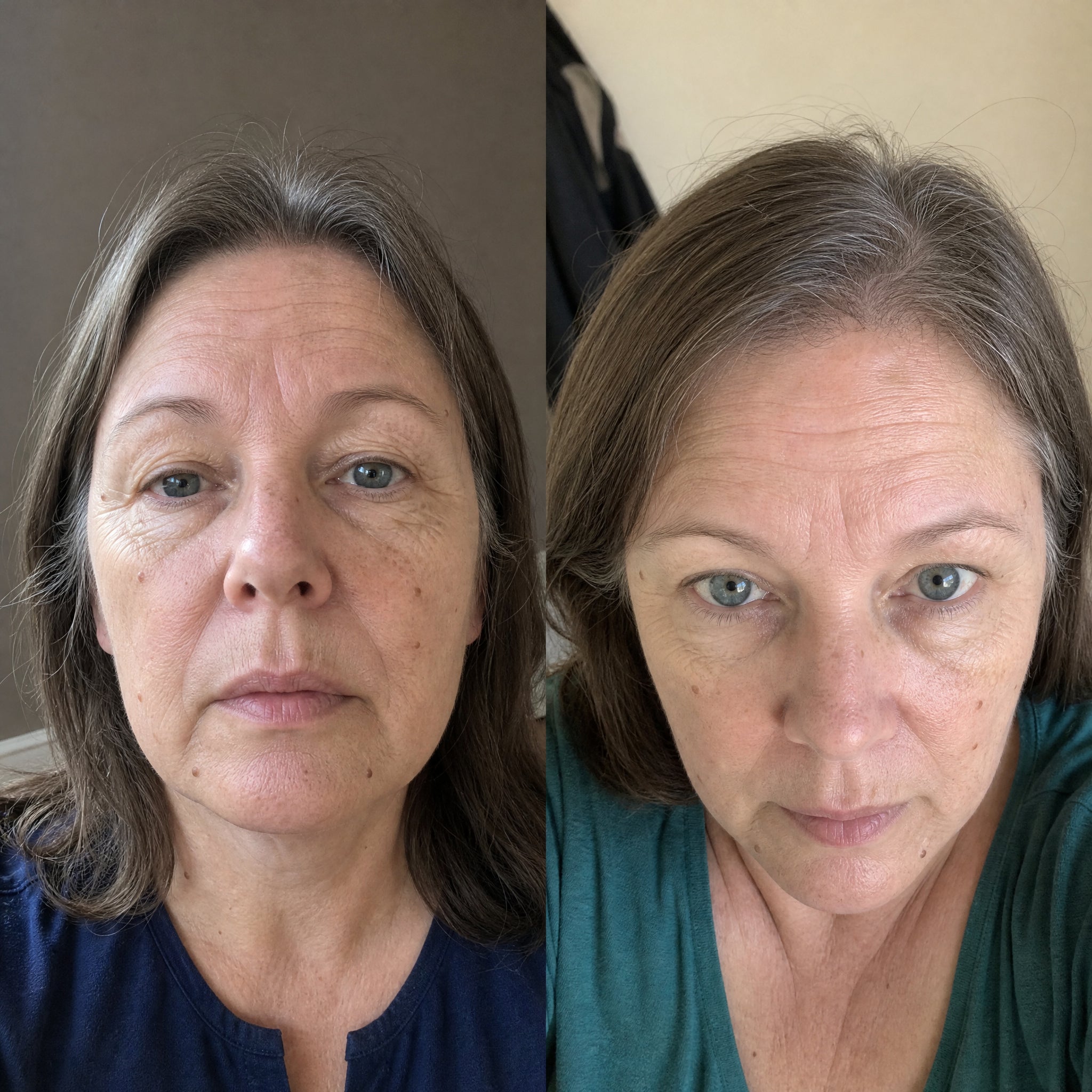 Before and after skin comparison showing softer fine lines and wrinkles
