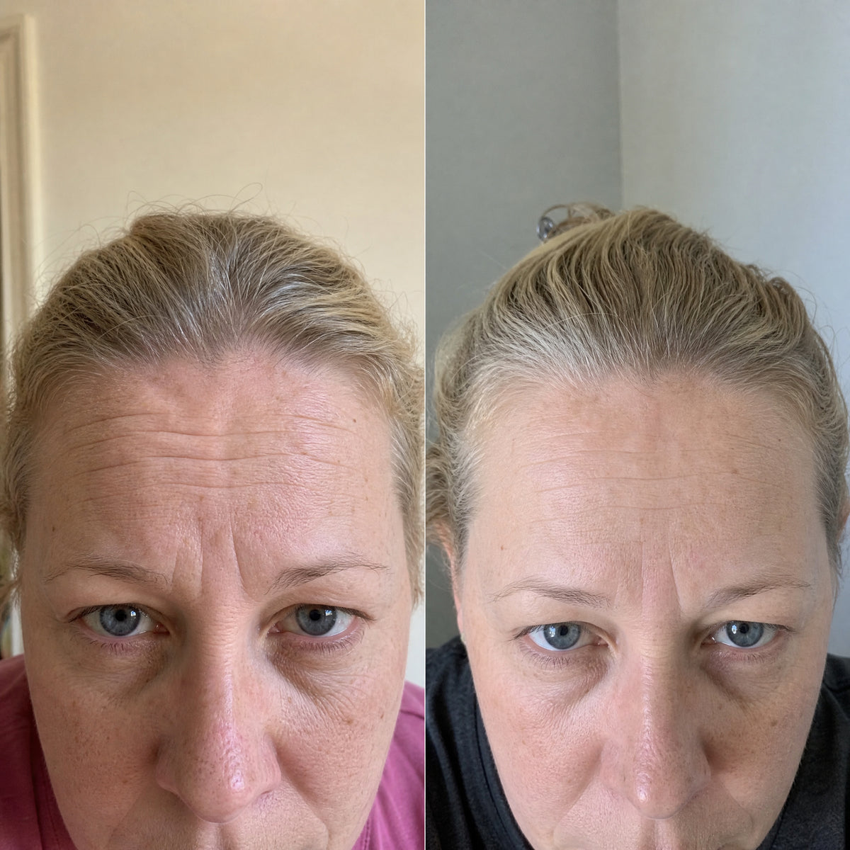Before and after skin comparison showing softer fine lines and wrinkles