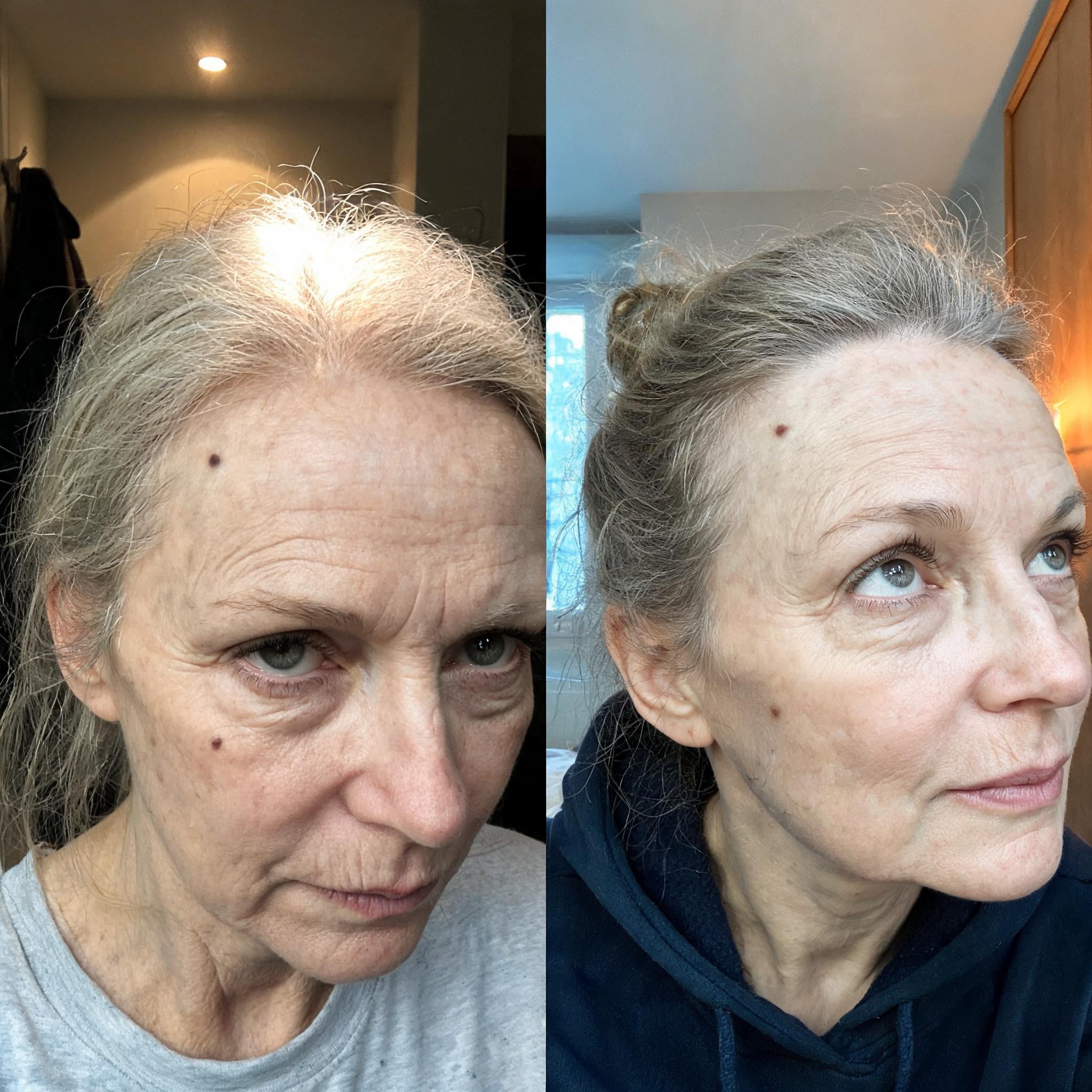 Before and after skin comparison showing softer fine lines and wrinkles
