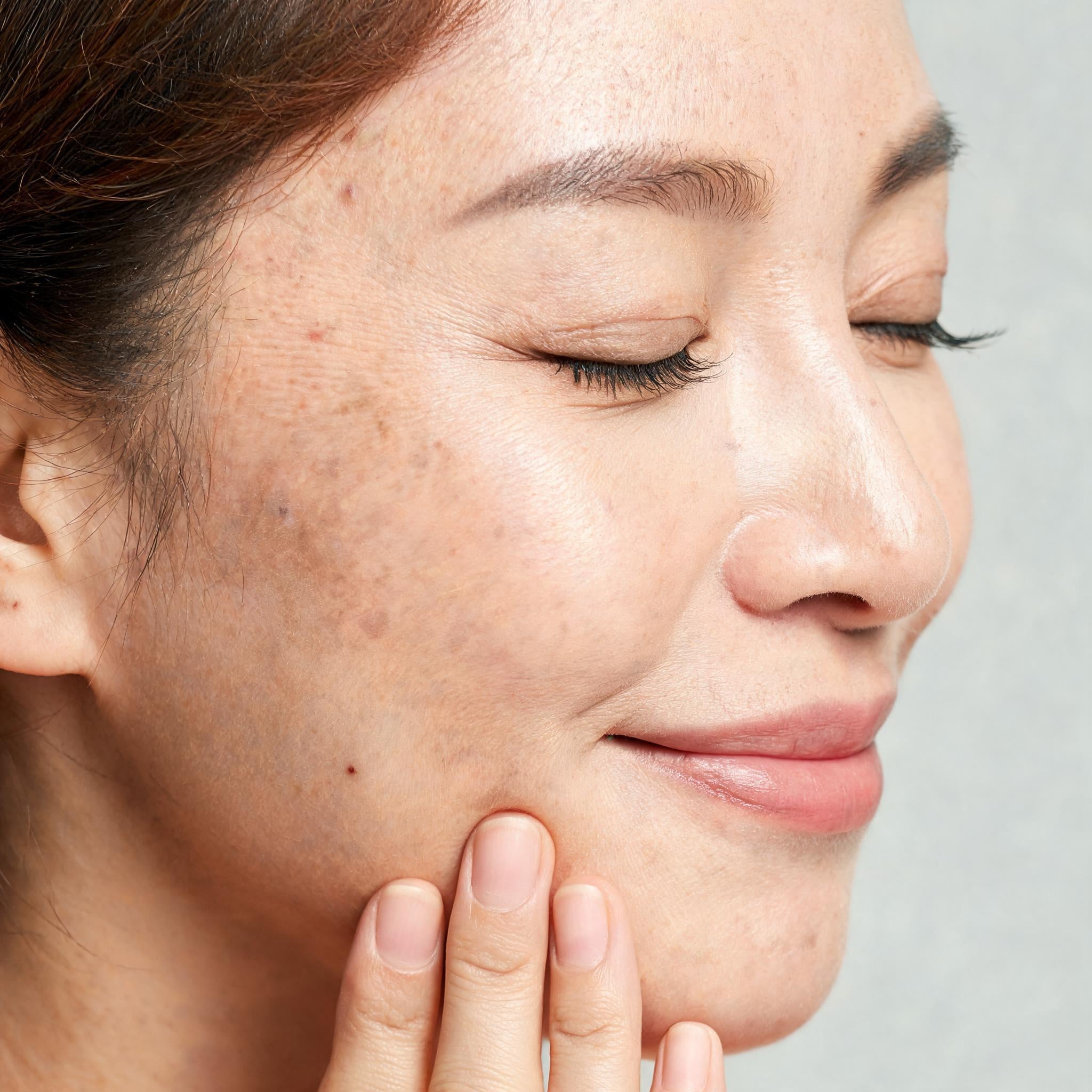 Close-up of a woman with her eyes closed resting the back of her fingers against her jaw, her cheek showing uneven tone and sun spots as the skin's natural renewal cycle slows with age