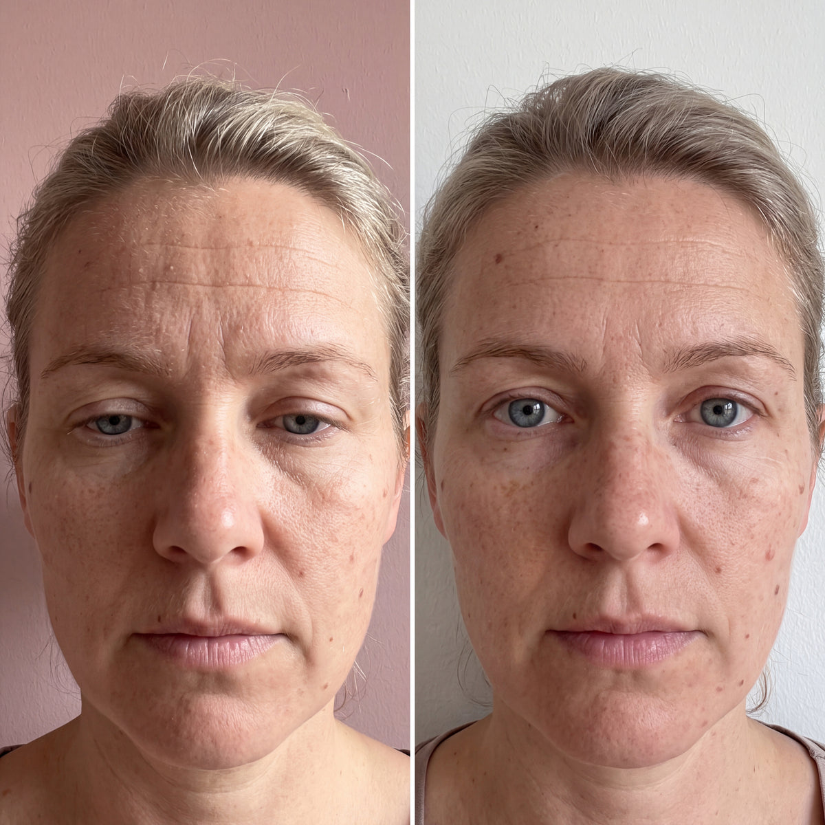 The same woman's forehead, before and after 20 days, with the forehead lines softer