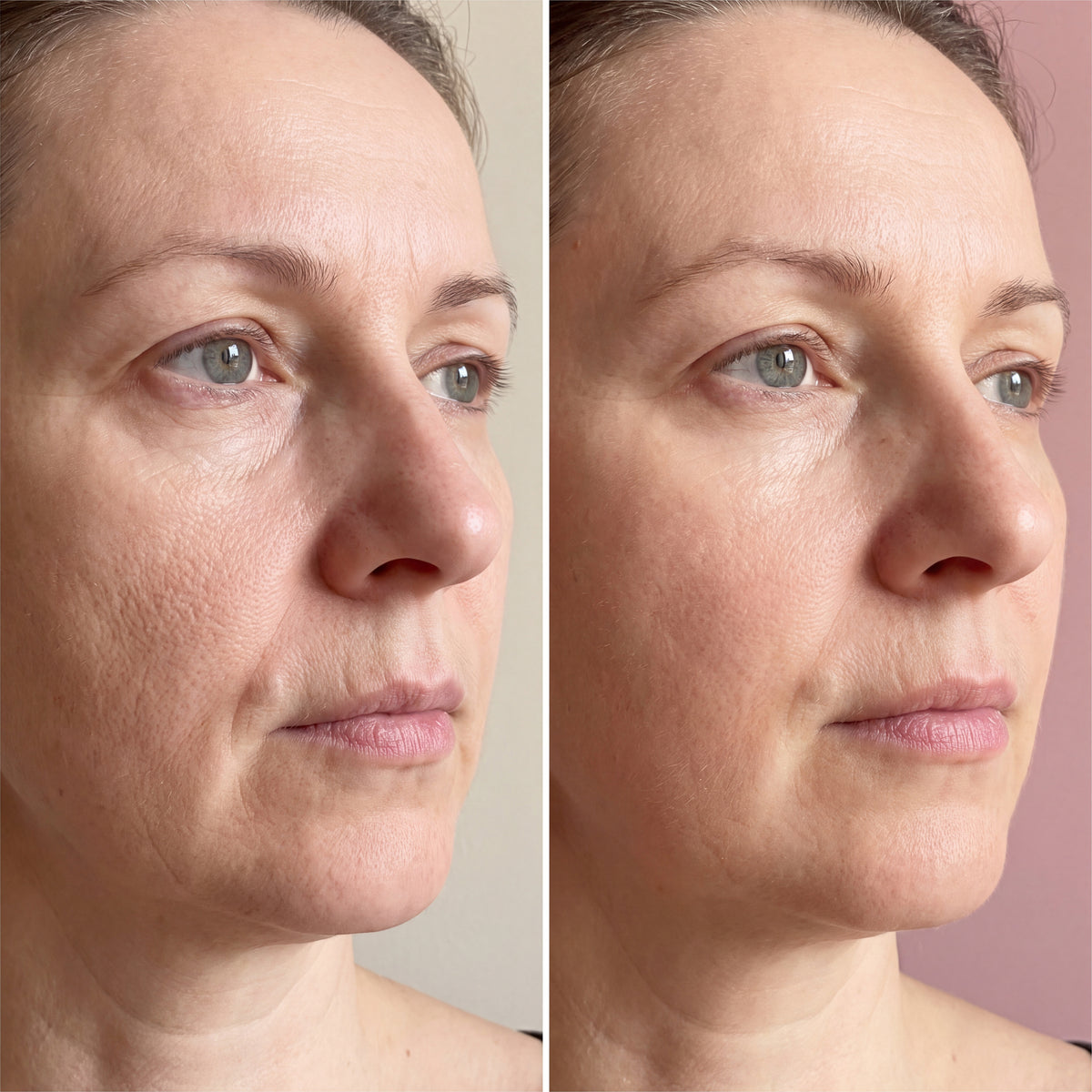 The same woman's cheek and jaw, before and after 12 weeks, with the cheek skin looking a little firmer and smoother
