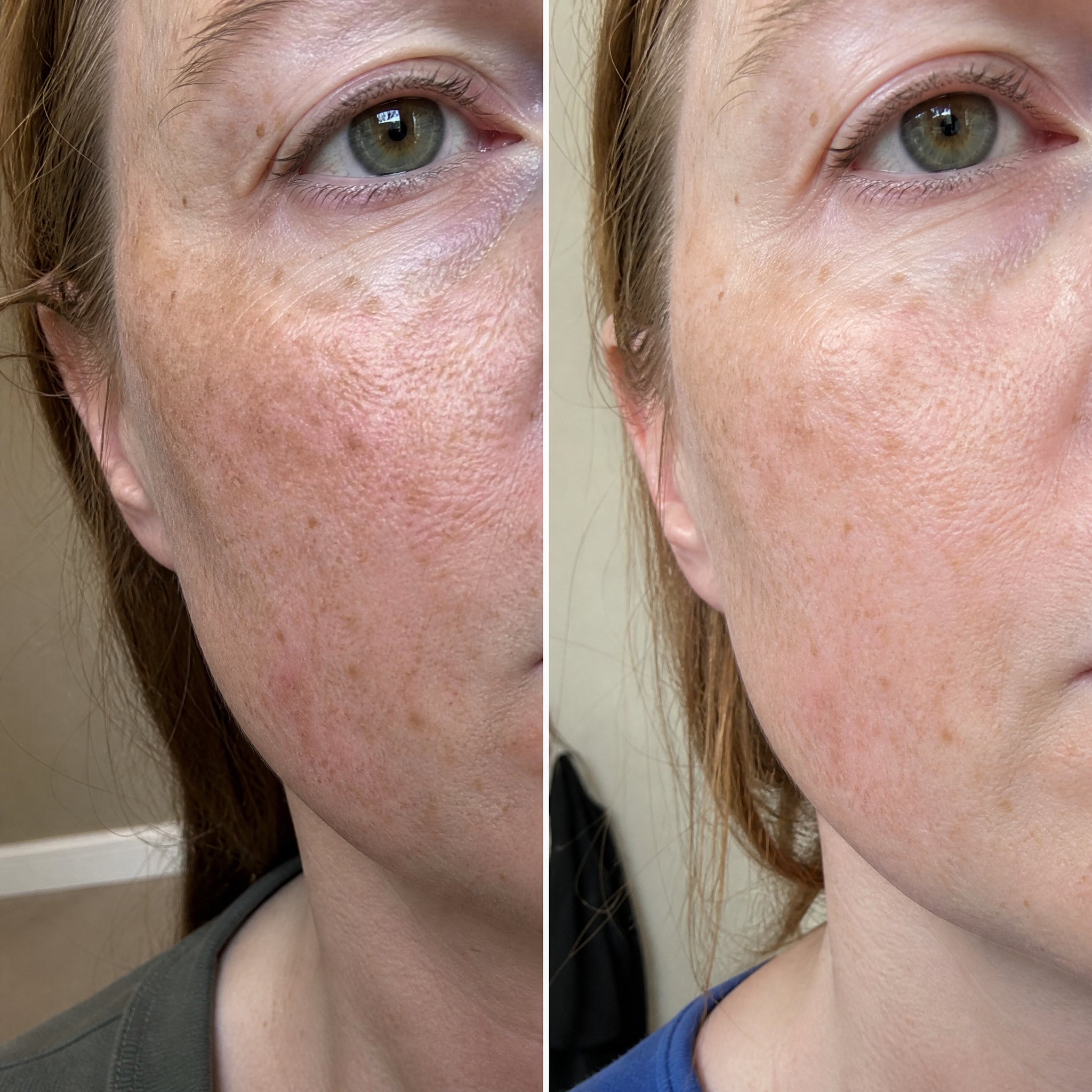 Illustration: two close photographs of the same woman's freckled cheek taken weeks apart side by side, the later one showing clearer, more even-looking skin between the freckles, which remain unchanged
