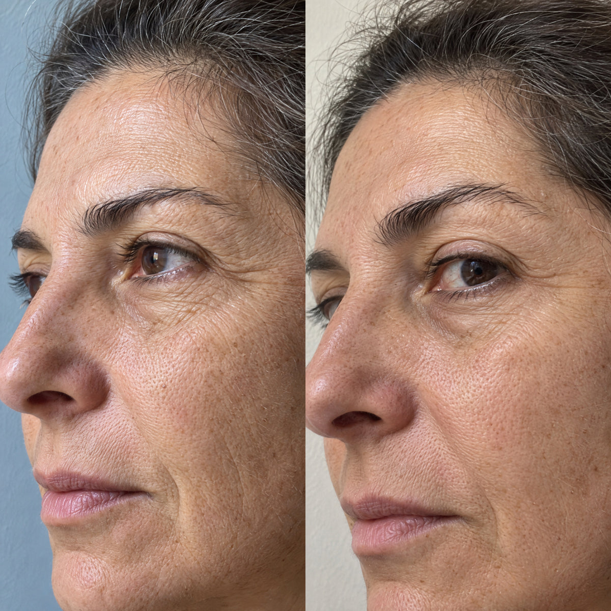 Before and after views of the same woman's eye corner, two months apart, illustrating the look of deep wrinkles softened in the manufacturer's half-face study of Matrixyl 3000