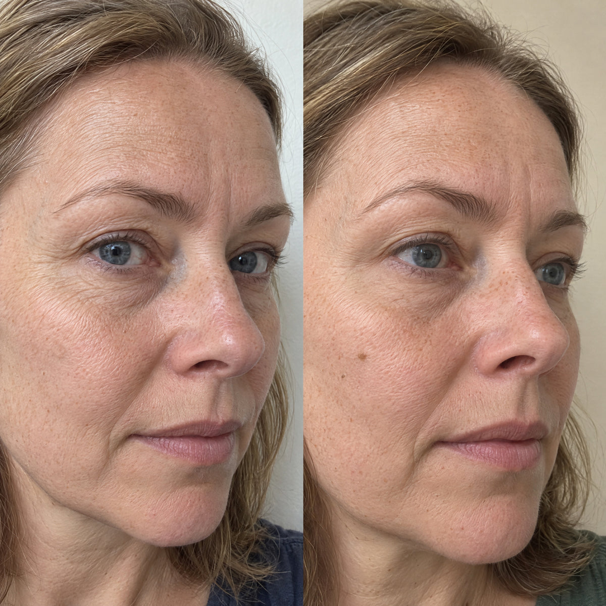 Before and after views of the same woman's cheek and eye area twelve weeks apart, illustrating fine lines reduced in the Robinson 2005 trial of palmitoyl pentapeptide-4