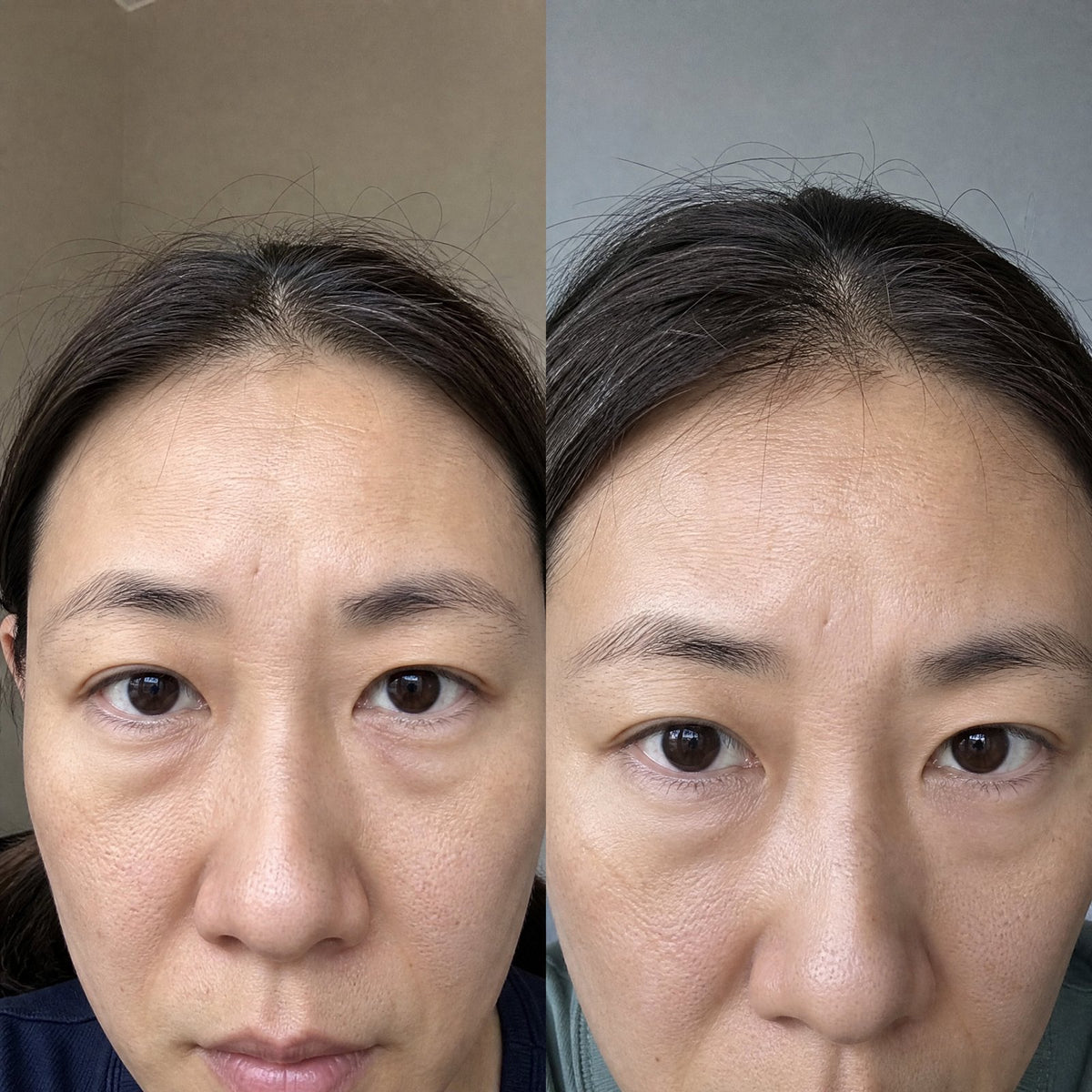 Before and after: lower-eyelid bags still present, slightly smaller