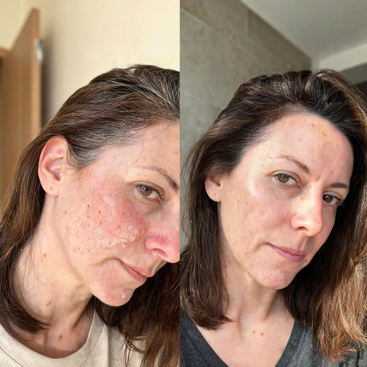 Before and after photographs from a Skingenetix customer, showing blemishes and redness on the cheek clearing