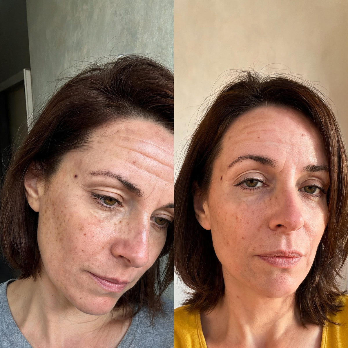 Before and after photographs from a Skingenetix customer, showing freckling and pigment across the cheek looking lighter and the overall tone fresher, with her freckles and forehead lines unchanged