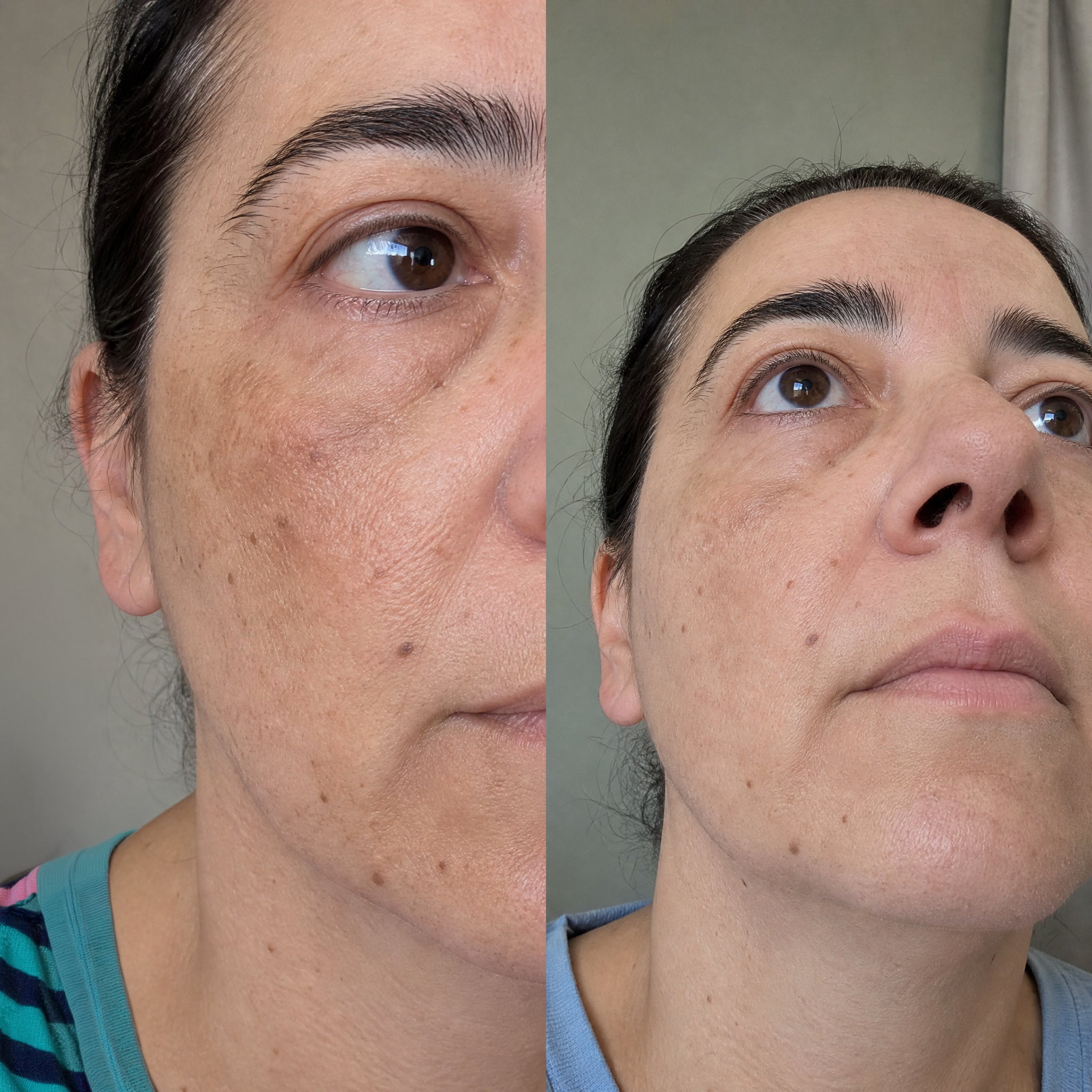 Before and after skin comparison showing a more even, brighter skin tone