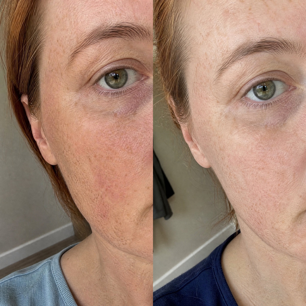 Before and after photographs from a Skingenetix customer, showing under-eye tone and brightness