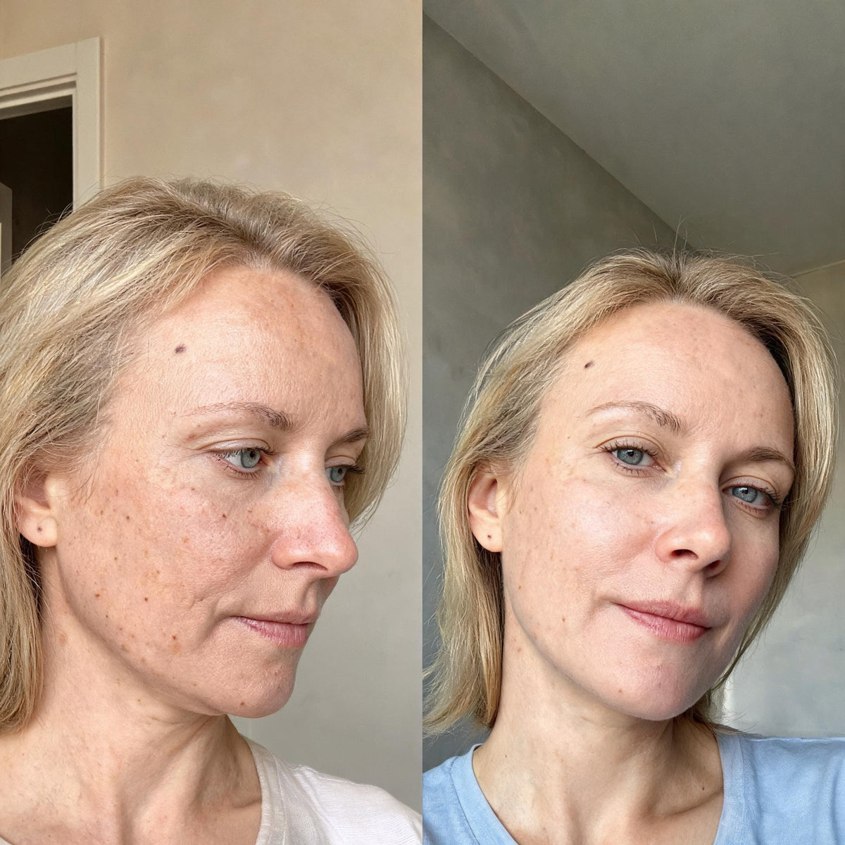 Before and after photographs from a Skingenetix customer, showing dull, uneven tone with scattered post-acne marks on the cheek looking brighter and more even, the marks softened rather than gone