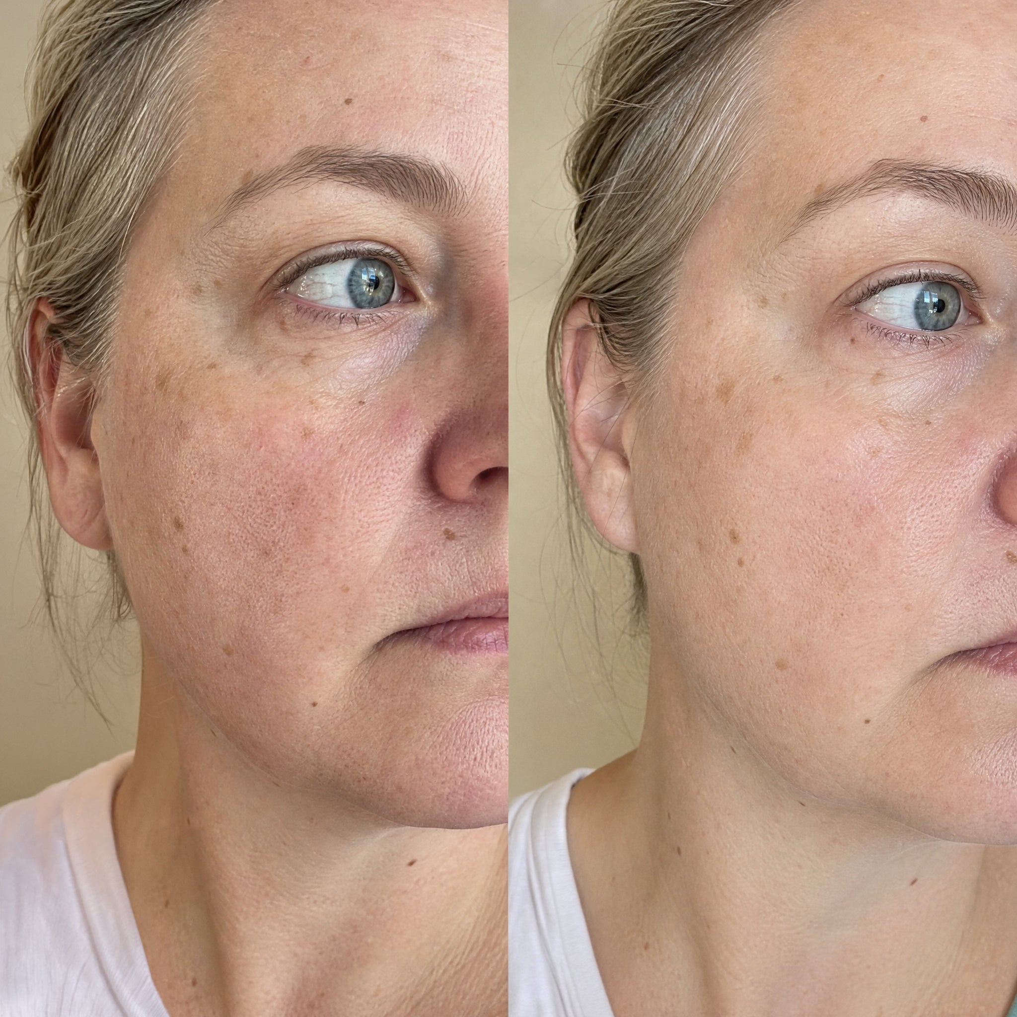 Before and after photographs from a Skingenetix customer, showing redness across the cheek settling and the tone looking more even, with the darker sun spots less pronounced but still present