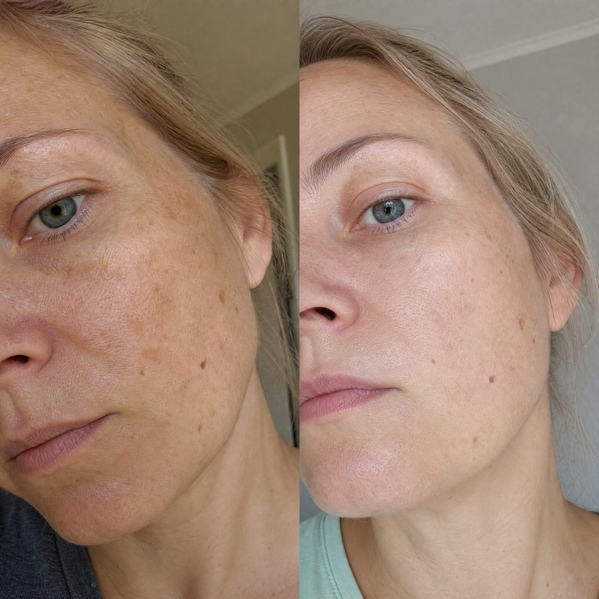 Before and after photographs from a Skingenetix customer, showing uneven freckled tone becoming more even