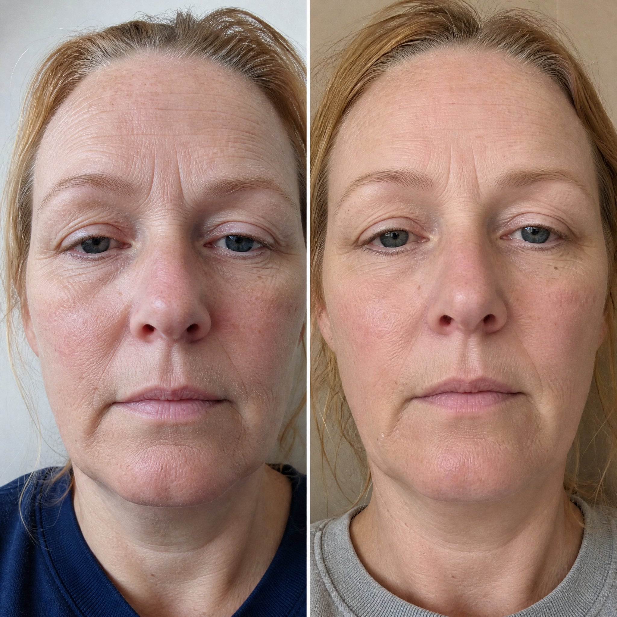 Before and after photographs from a Skingenetix customer, showing flushed redness across the cheeks and nose settling to a calmer, more even tone