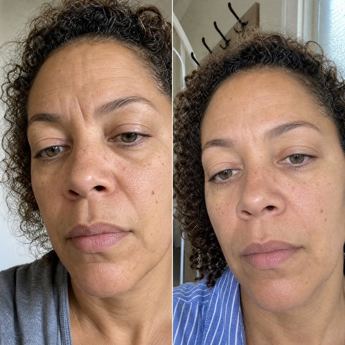 Before and after skin comparison showing softer fine lines and wrinkles