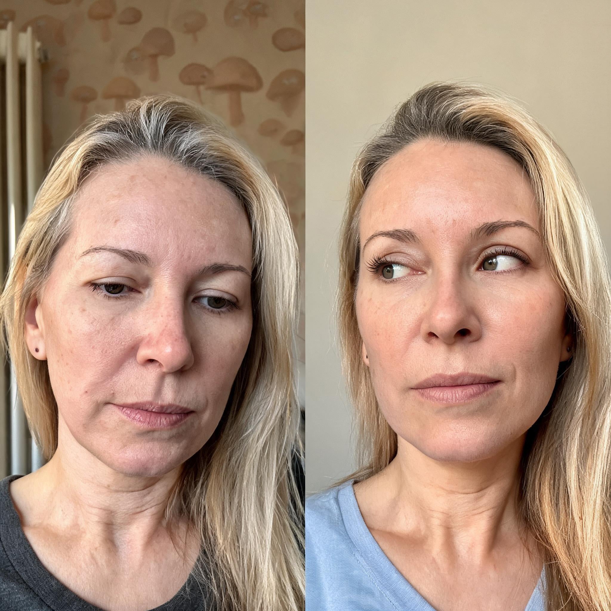 Before and after photographs from a Skingenetix customer, showing jawline and neck laxity tightening