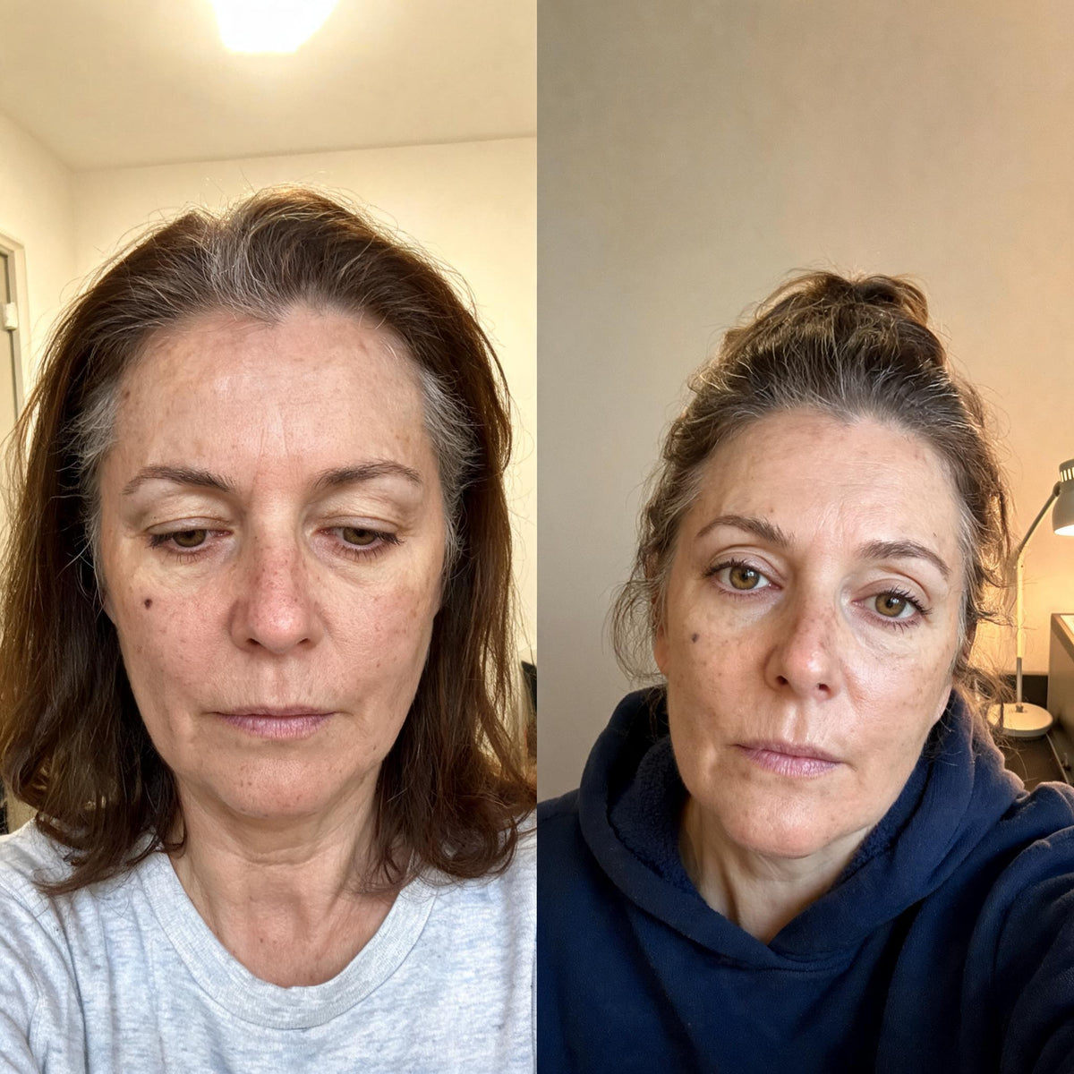 Before and after skin comparison showing firmer, better supported skin along the jaw and cheek
