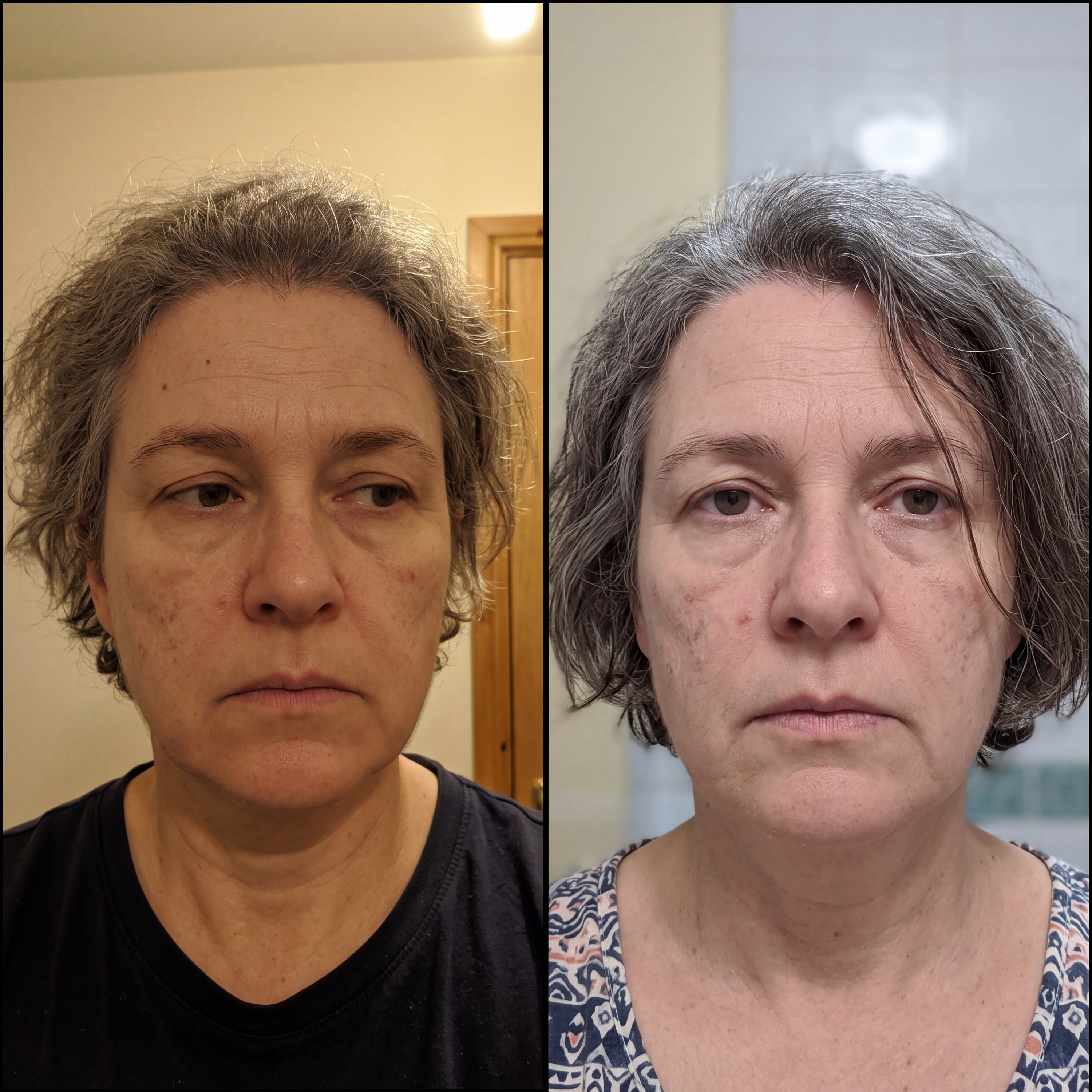 Before and after photographs from a Skingenetix customer, showing jowls firming across the lower face