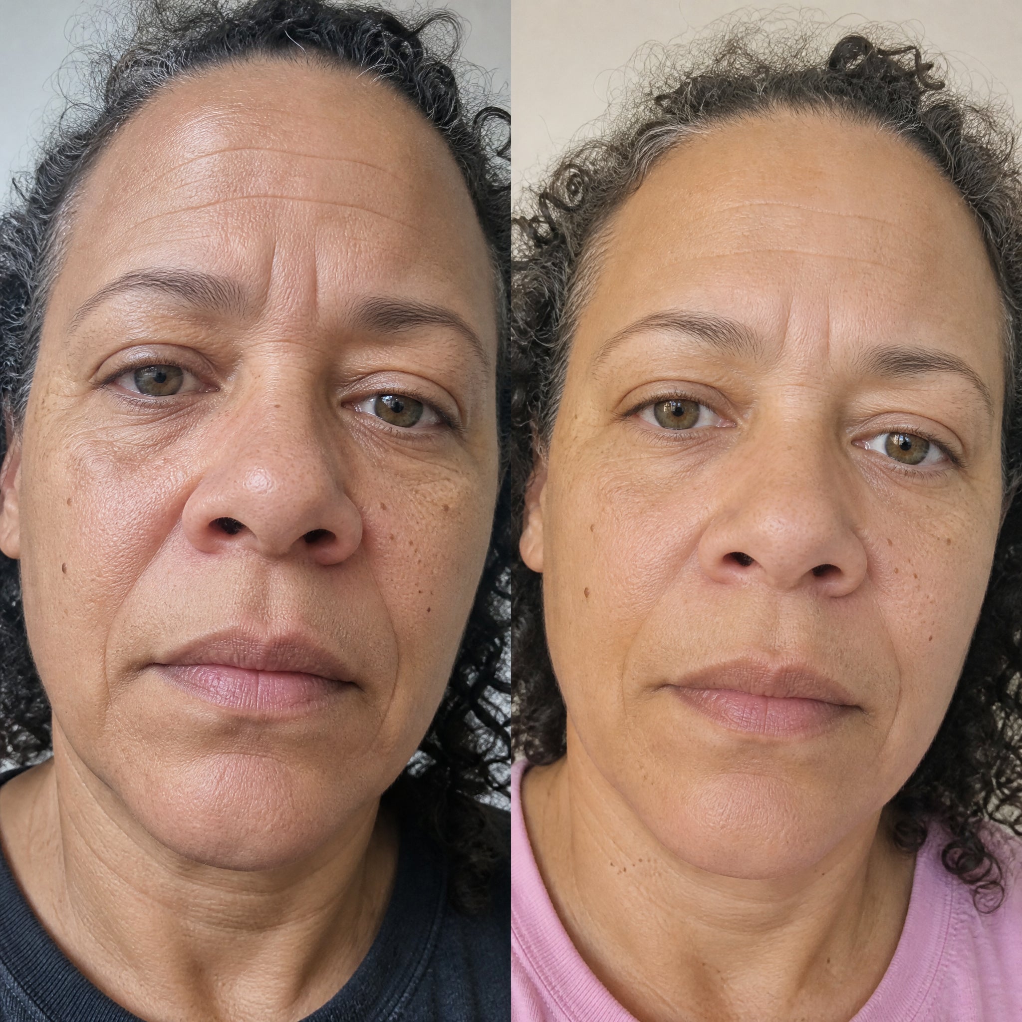 Before and after firming and skin density results from a Skingenetix customer