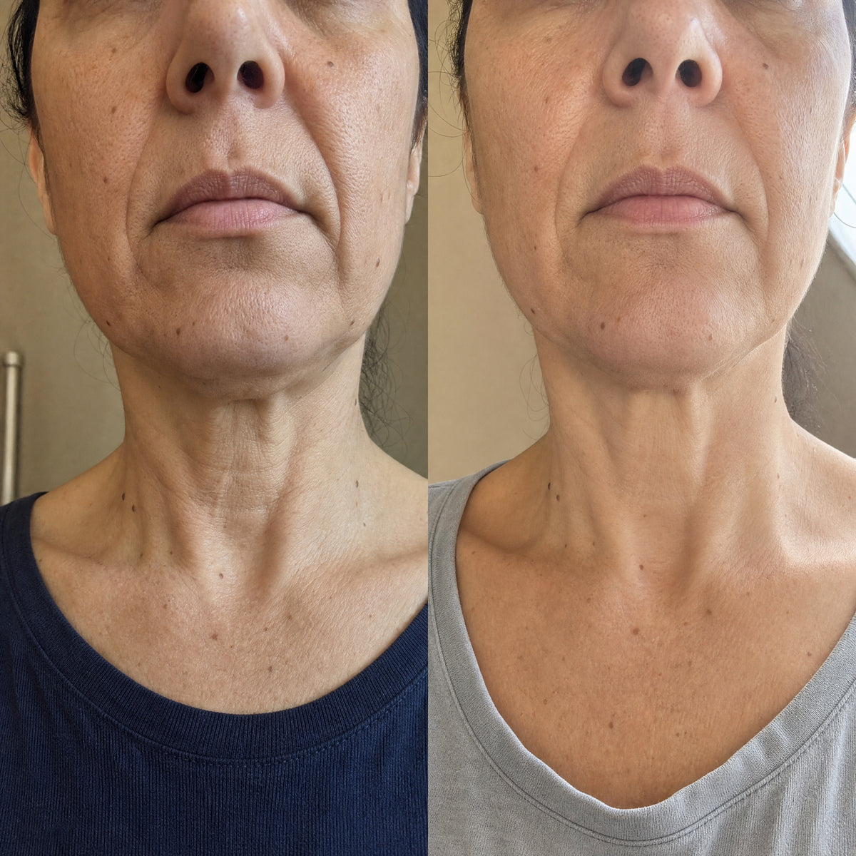Before and after skin comparison showing firmer, better supported skin along the jaw and cheek