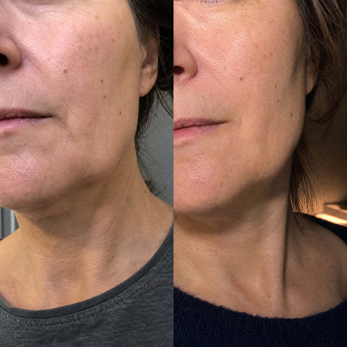 Before and after photographs from a Skingenetix customer, showing jaw and neck in macro, marionette lines