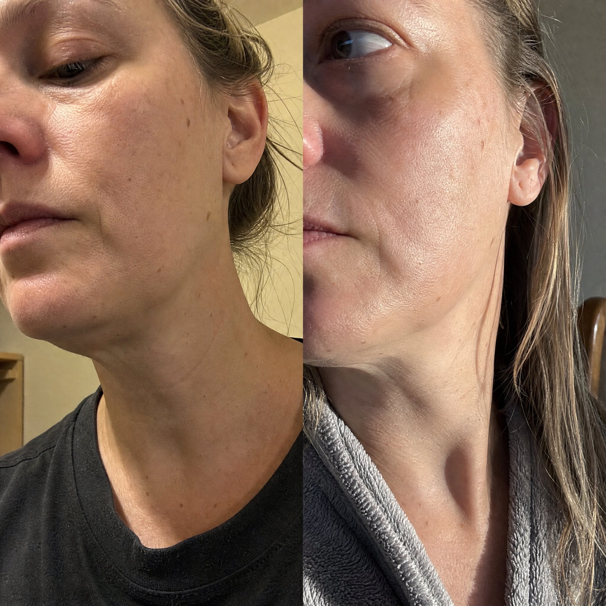 Before and after skin comparison showing firmer, better supported skin along the jaw and cheek
