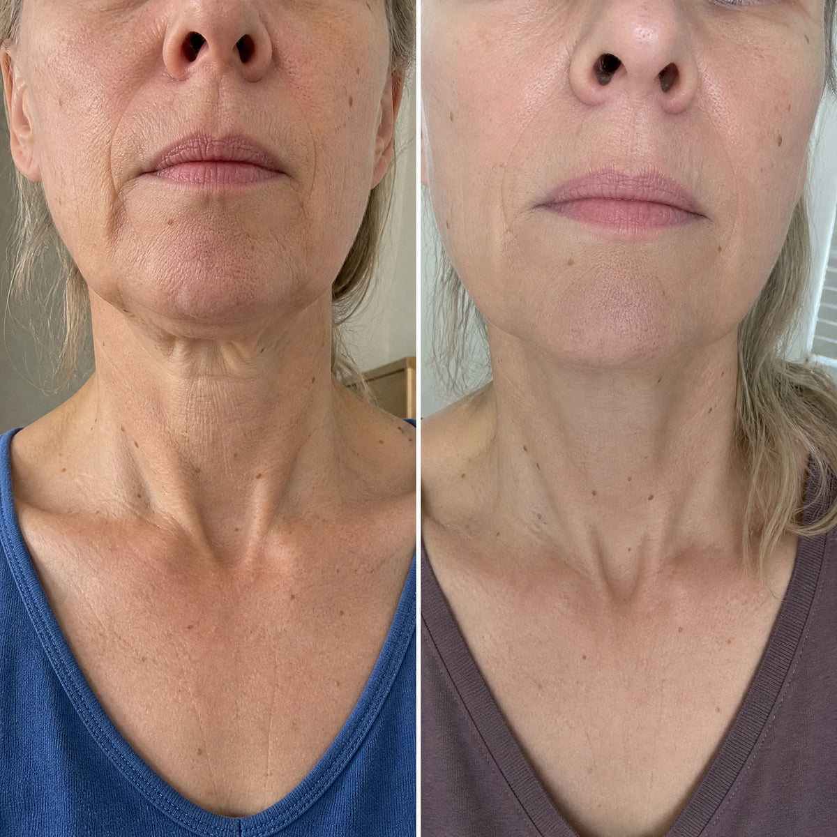 Before and after skin comparison showing firmer, better supported skin along the jaw and cheek