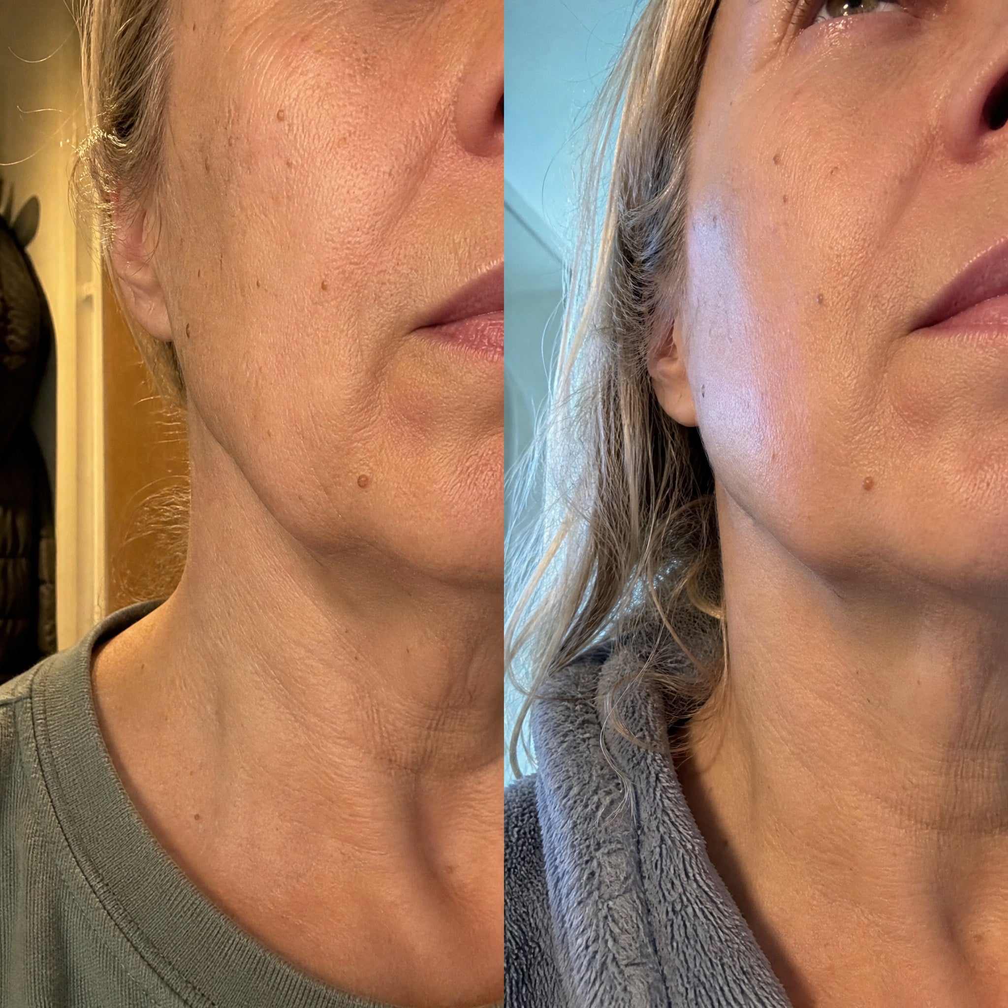 Before and after skin comparison showing firmer, better supported skin along the jaw and cheek