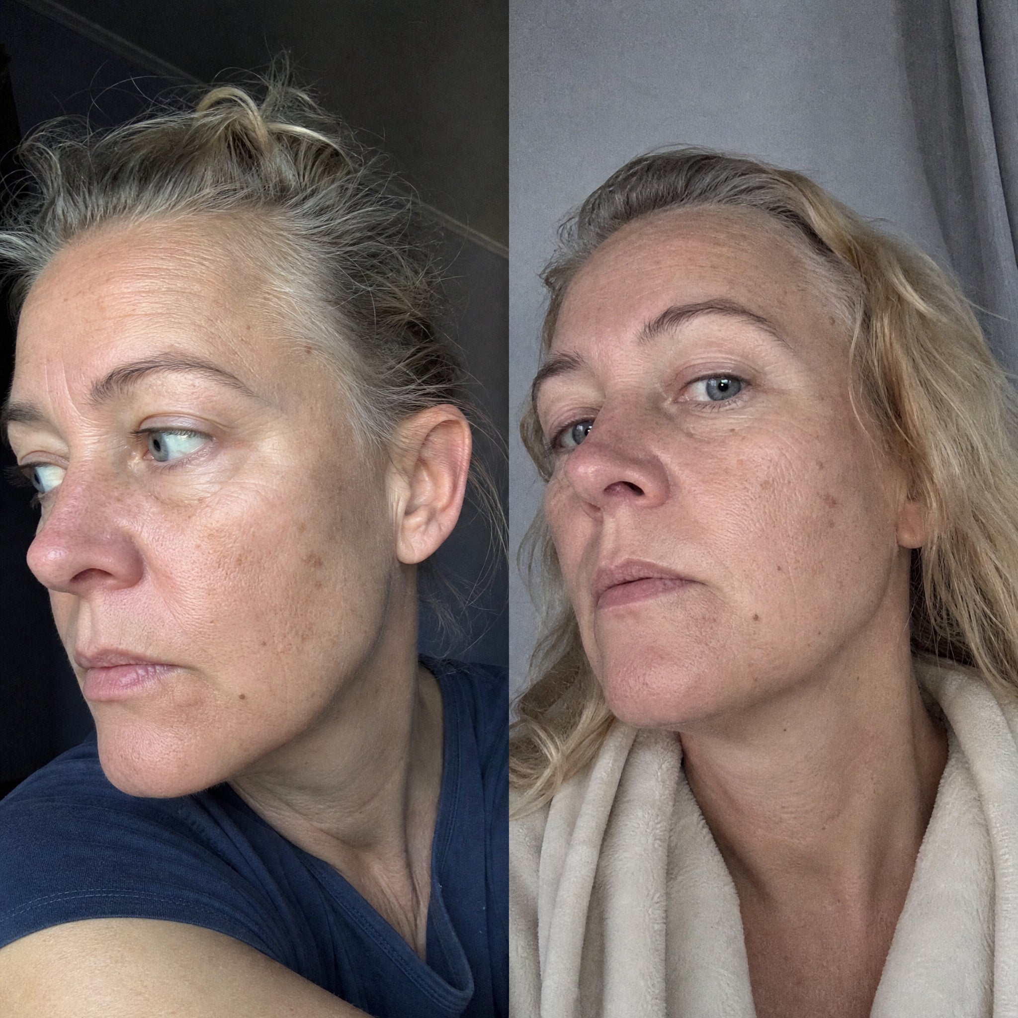 Before and after photographs from a Skingenetix customer, showing jaw and neck firmness