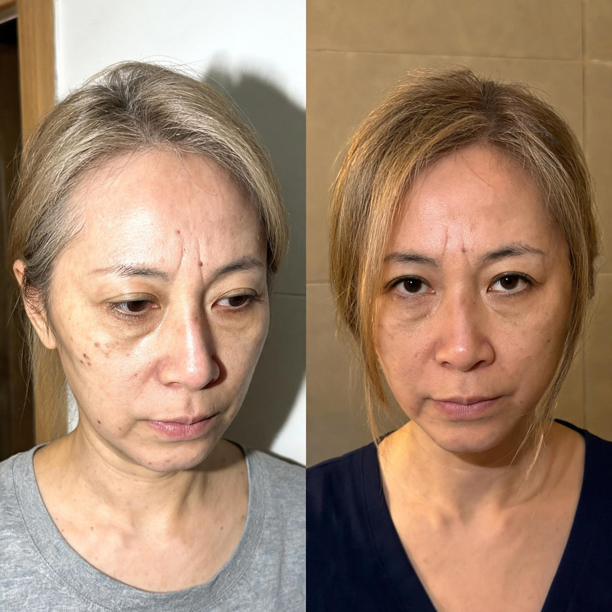 Before and after photographs from a Skingenetix customer, showing nasolabial fold and jowl lifting
