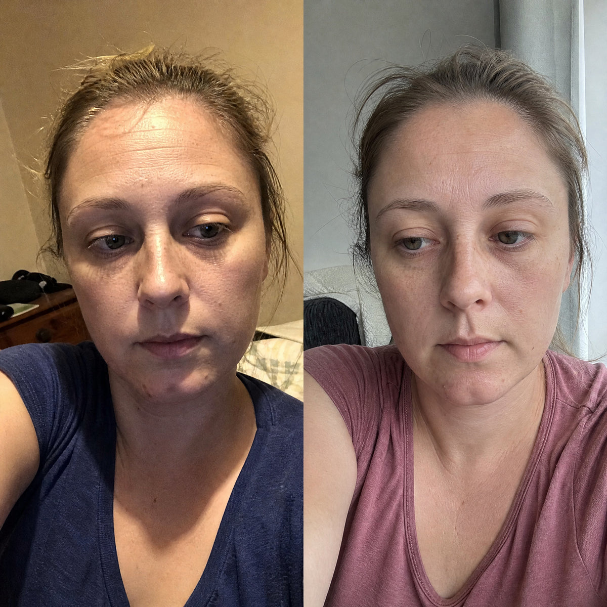 Before and after photographs from a Skingenetix customer, showing tired, hollow under-eye looking fresher