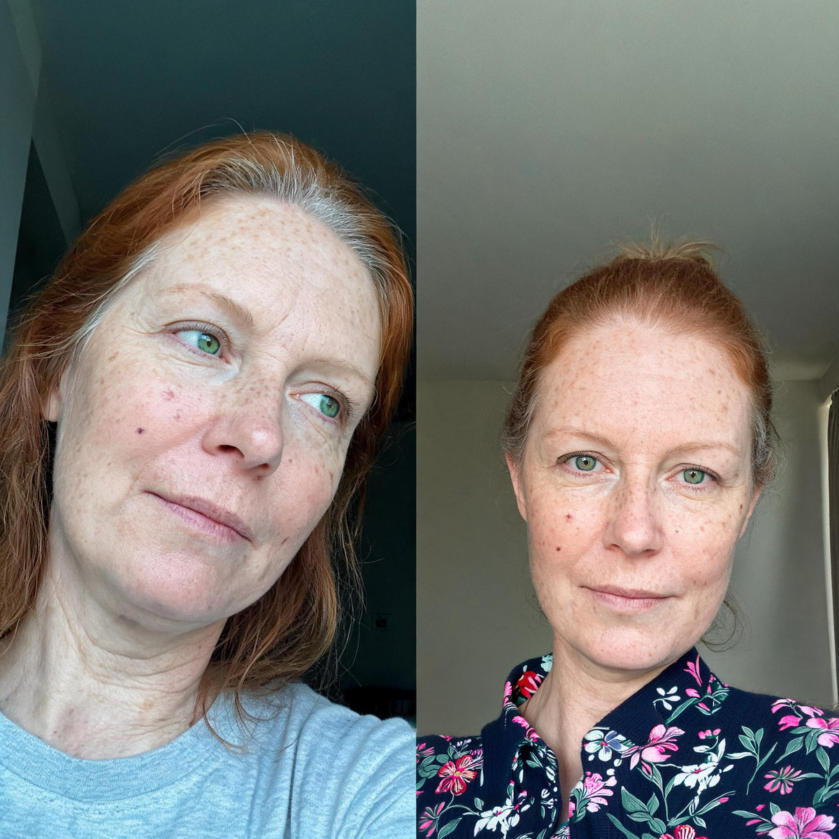 Before and after skin comparison showing firmer, better supported skin along the jaw and cheek